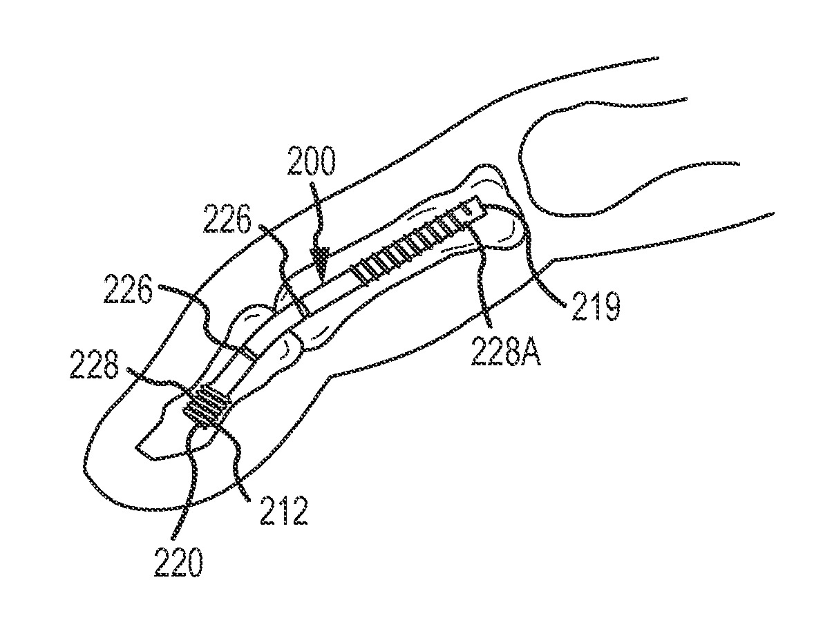 Bent dip fusion screw