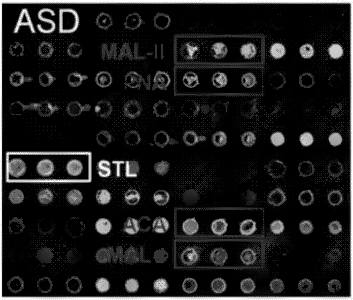 Application of a serum glycoprotein marker for autism