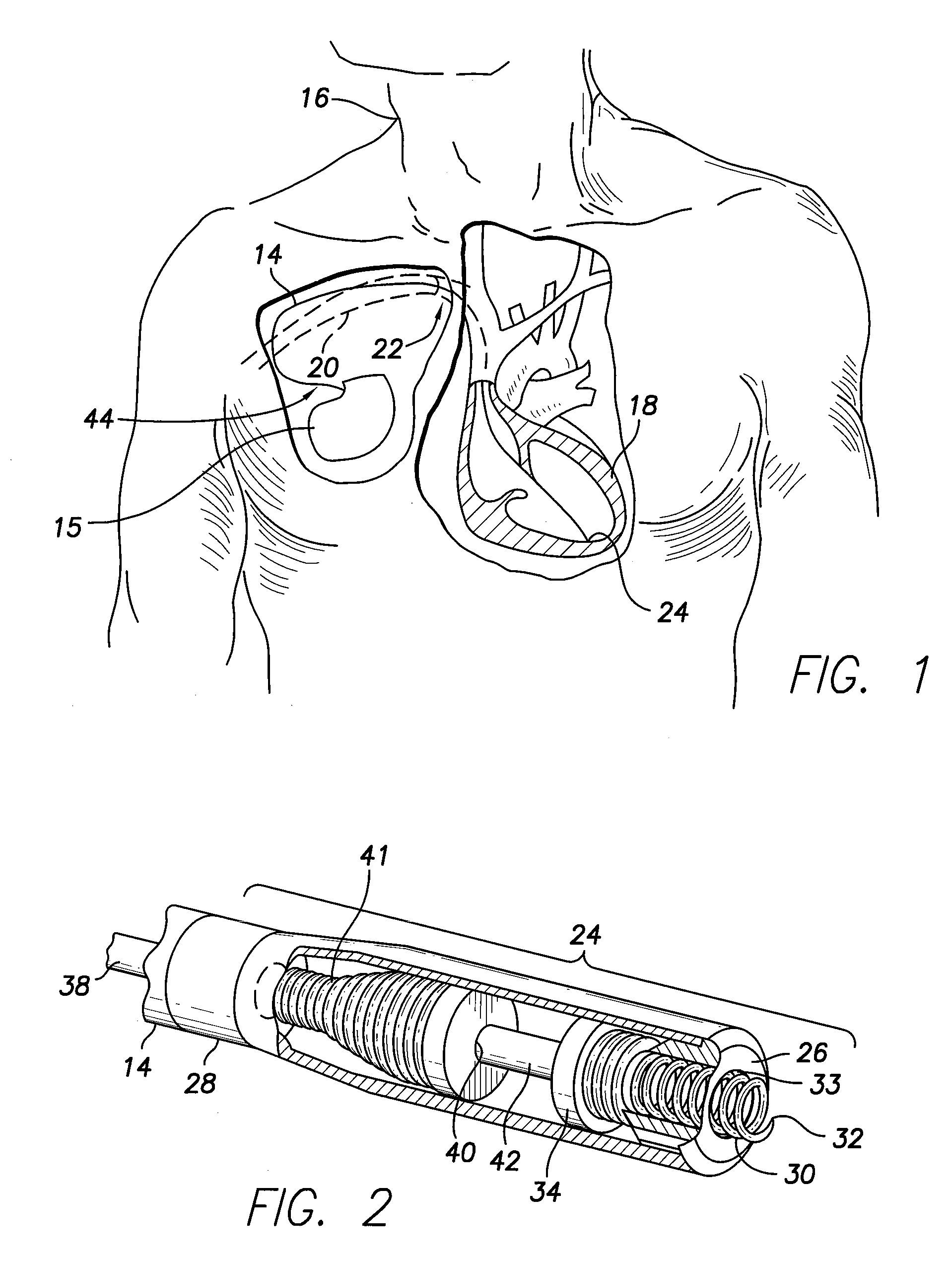 Device and method for the implantation of active fixation medical leads