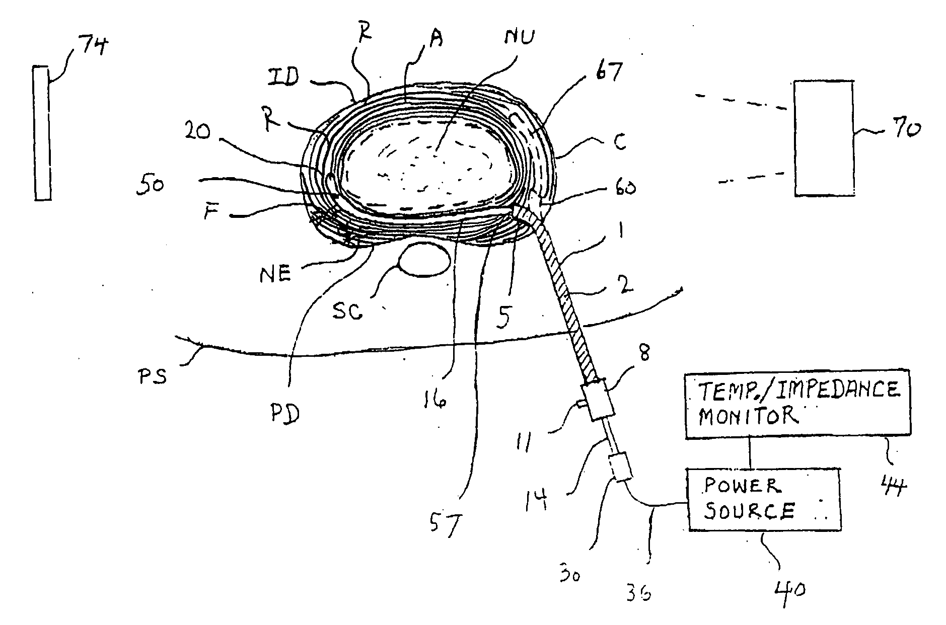 Apparatus for thermal treatment of an intervertebral disc