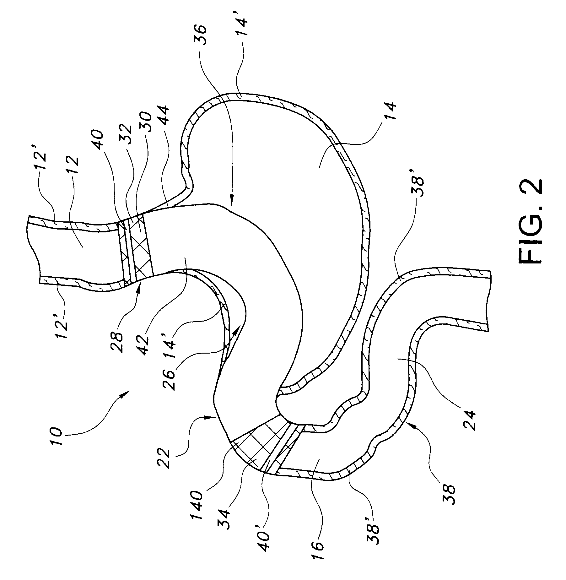 Stomach bypass for the treatment of obesity