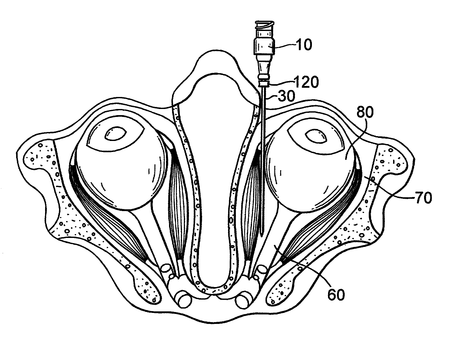 Method and apparatus for treatment of amblyopia