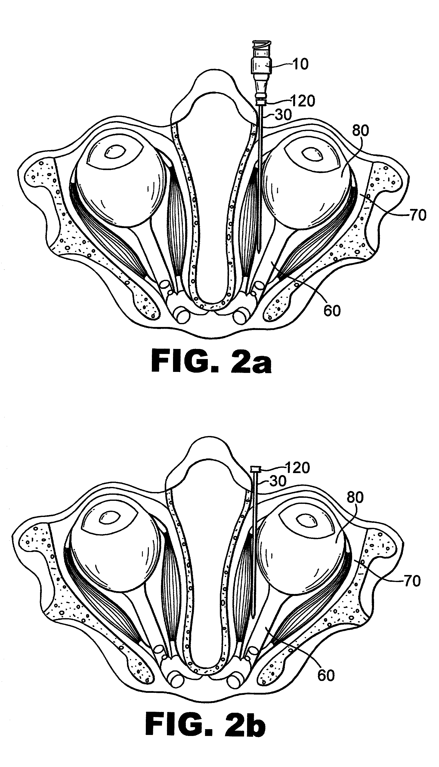 Method and apparatus for treatment of amblyopia