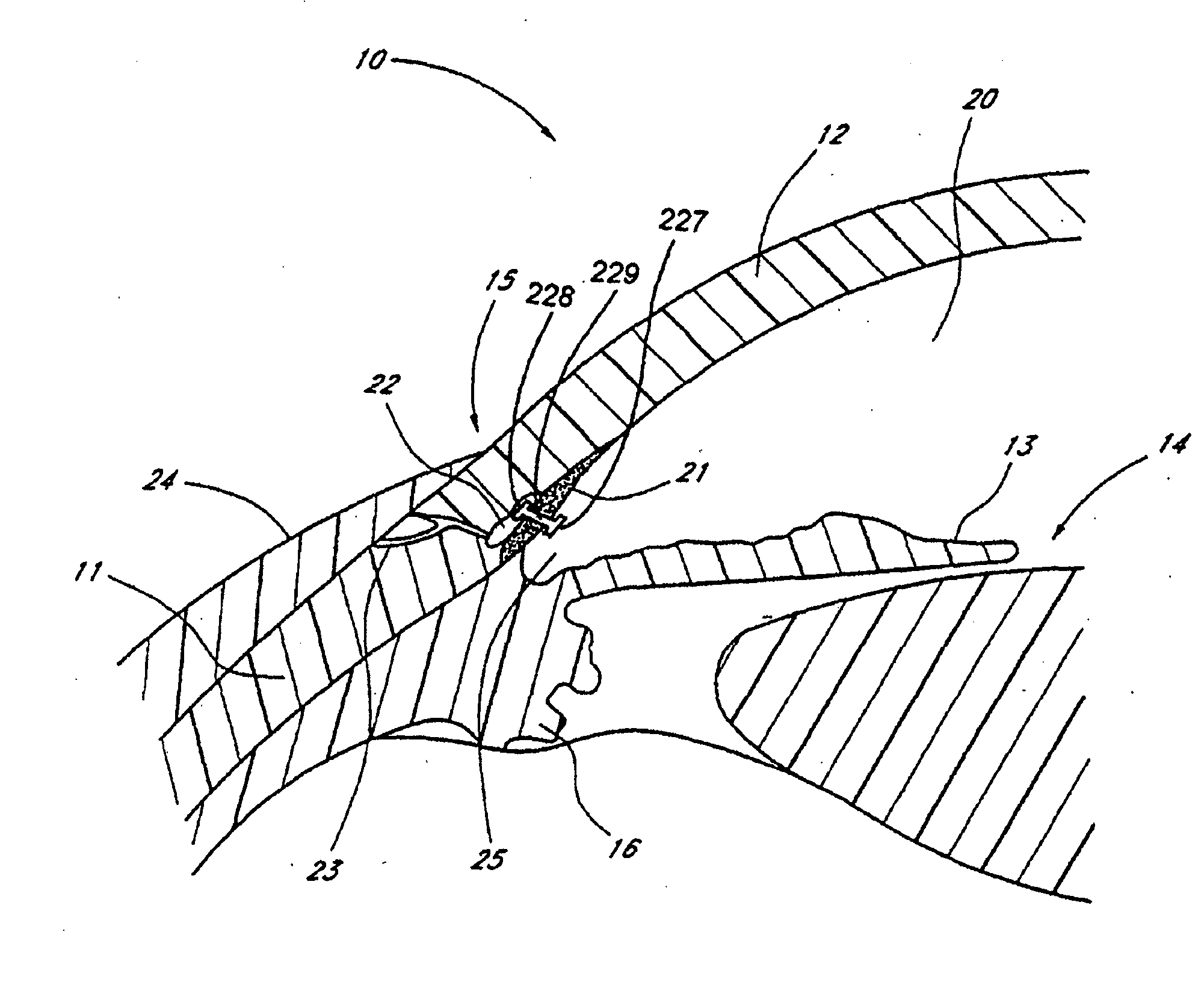 Devices and methods for glaucoma treatment