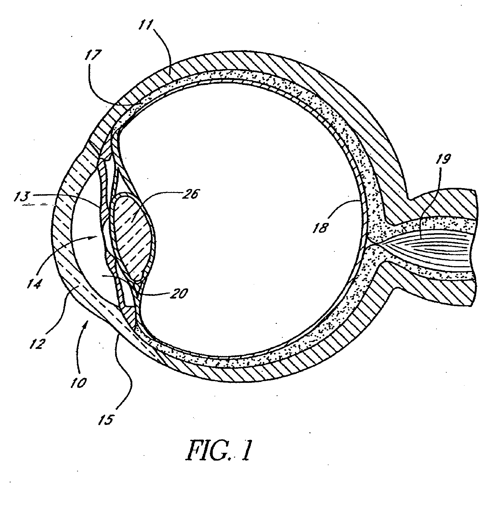 Devices and methods for glaucoma treatment