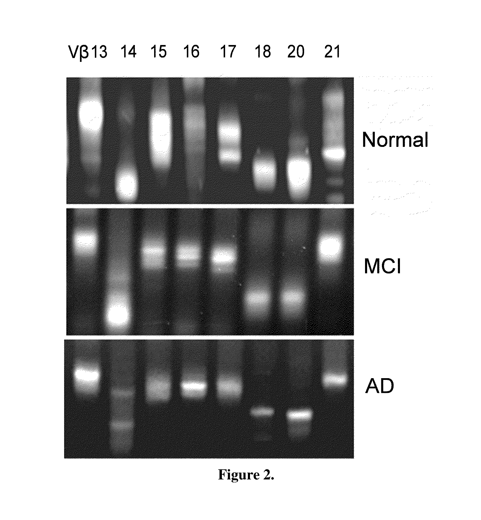 Method of diagnosing or assessing risk for Parkinson's disease or Alzheimer's disease using TCR clonality