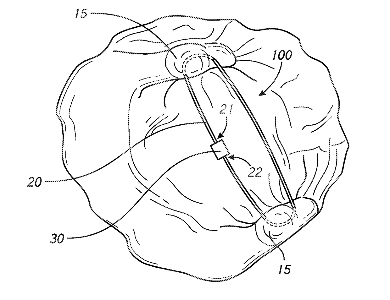 Papillary muscle binding