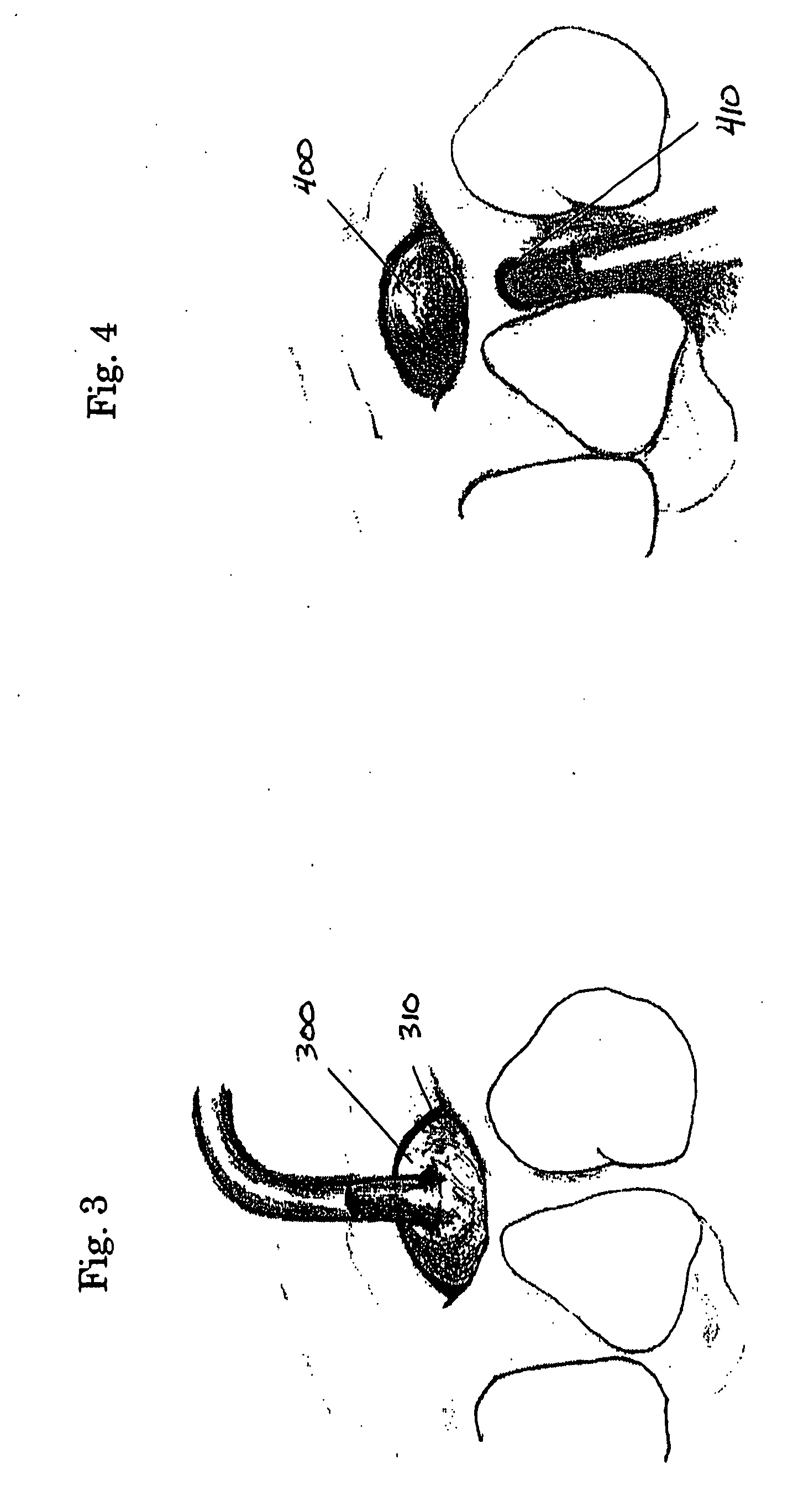 Collagen antral membrane expander