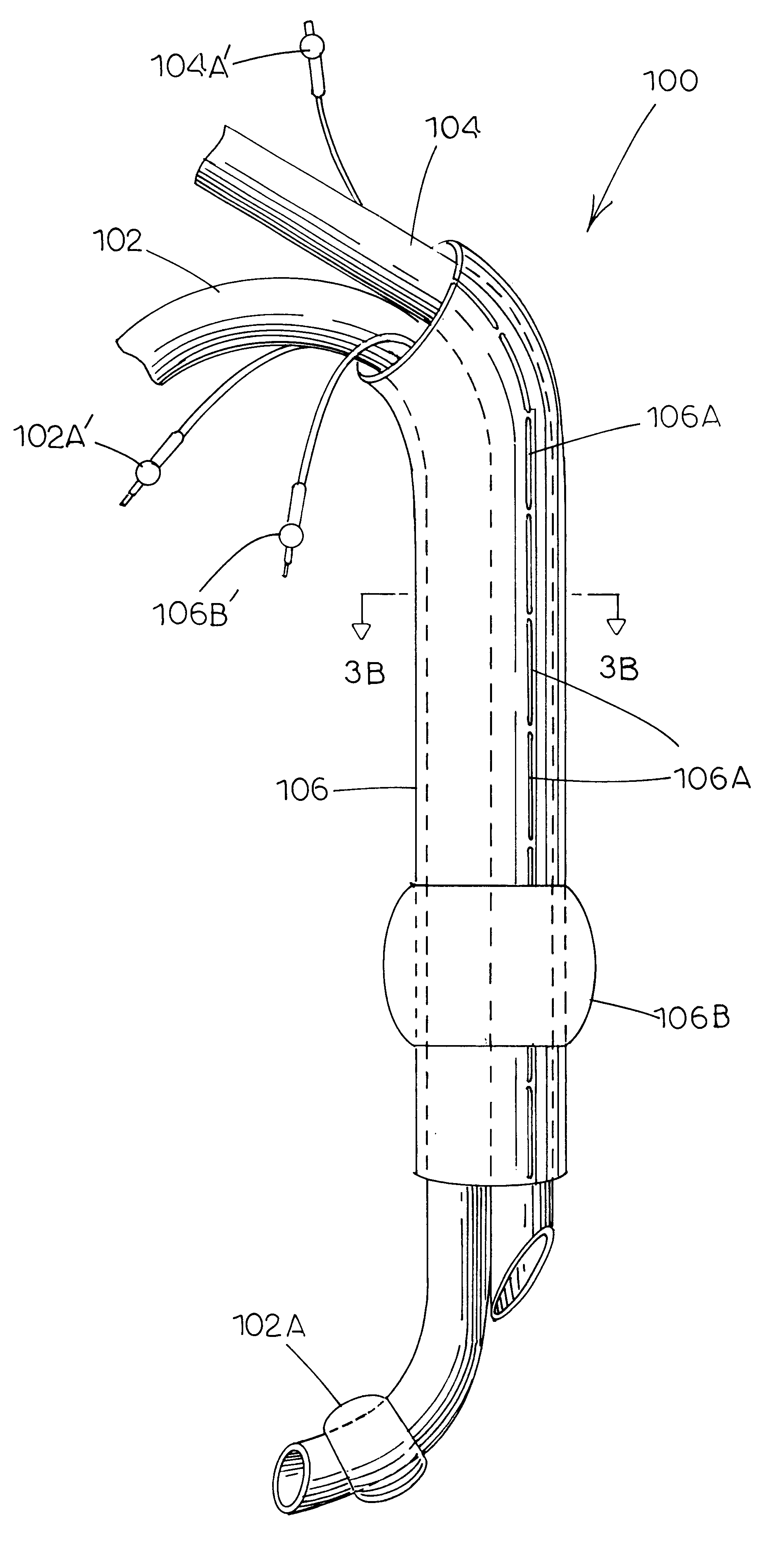 Separable double lumen endotracheal tube