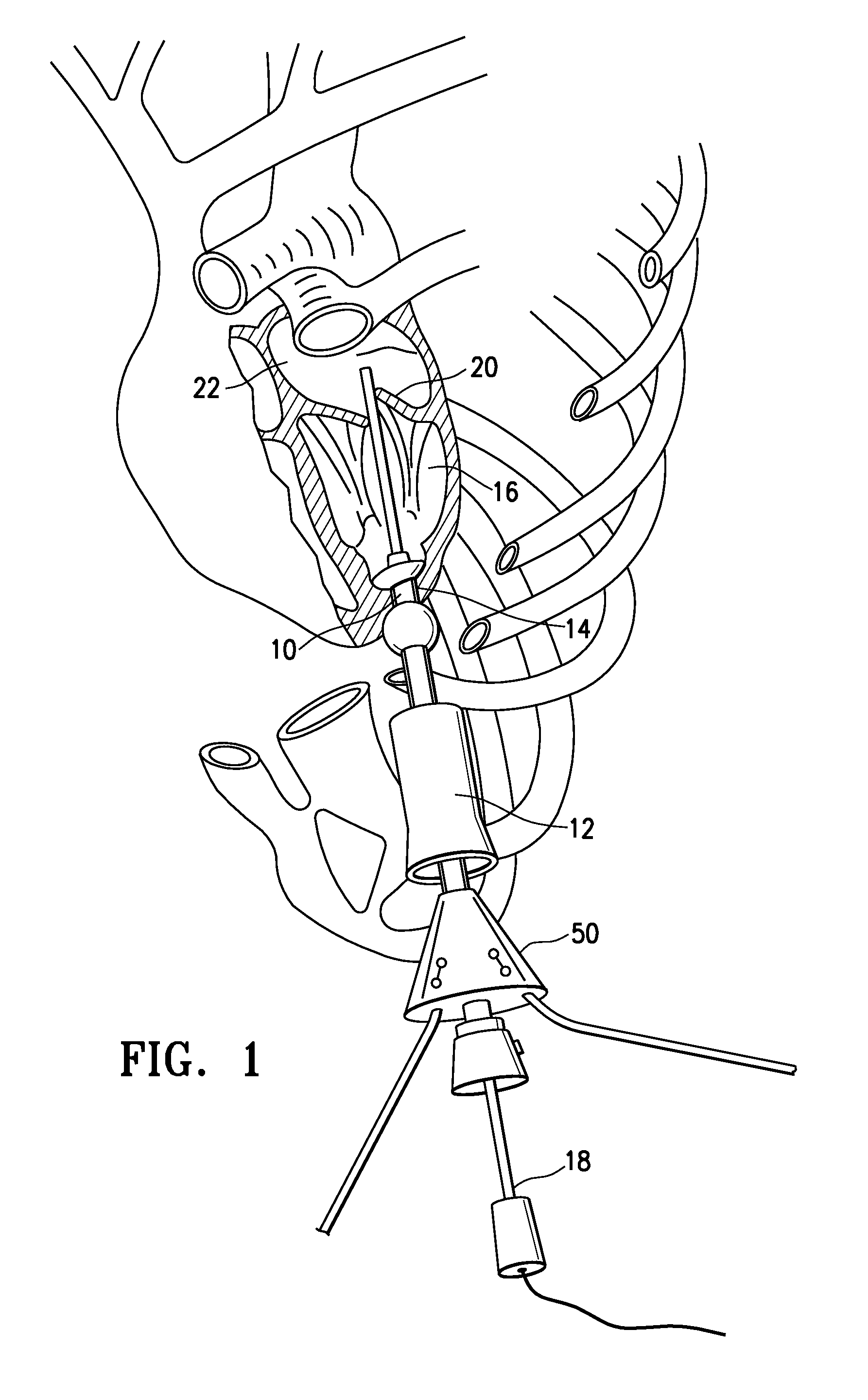 Apical Instrument Port