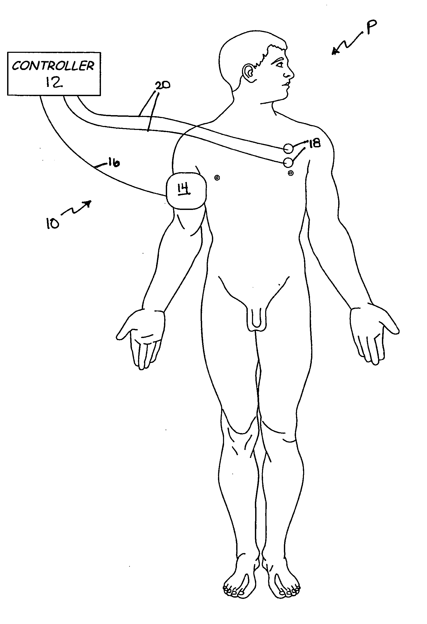 System and method for regulating blood pressure and electrolyte balance