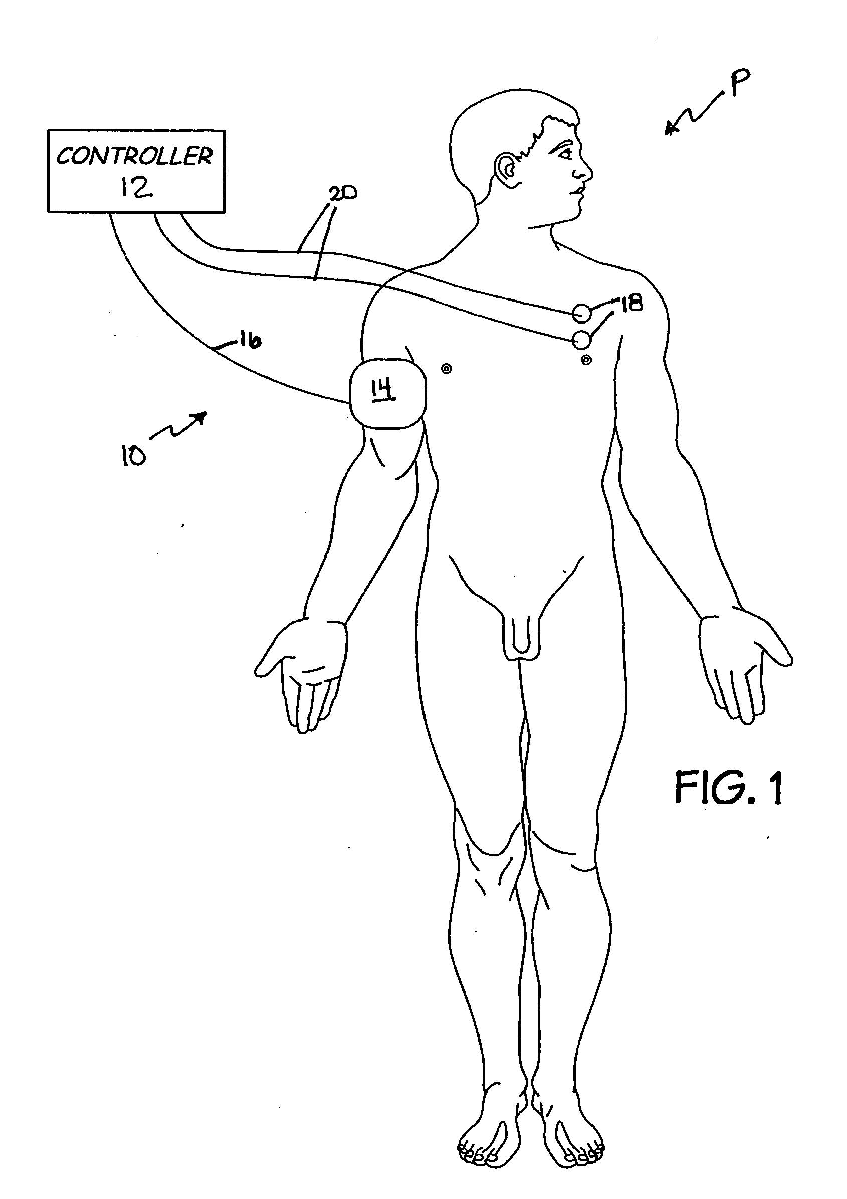 System and method for regulating blood pressure and electrolyte balance