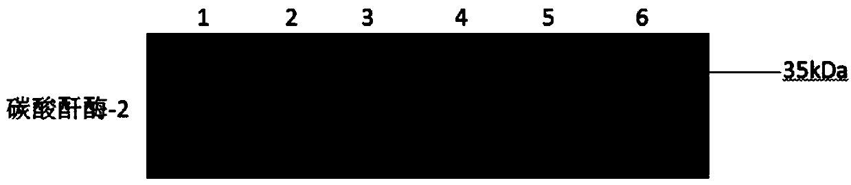 Application of carbonic anhydrase-2 as detection marker in diagnosis of kidney stones