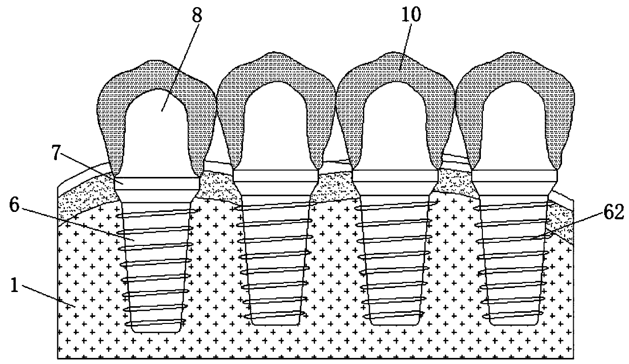 A full mouth edentulous implant restoration system