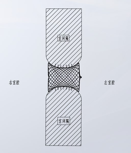 EY ventricular septal defect plugging device