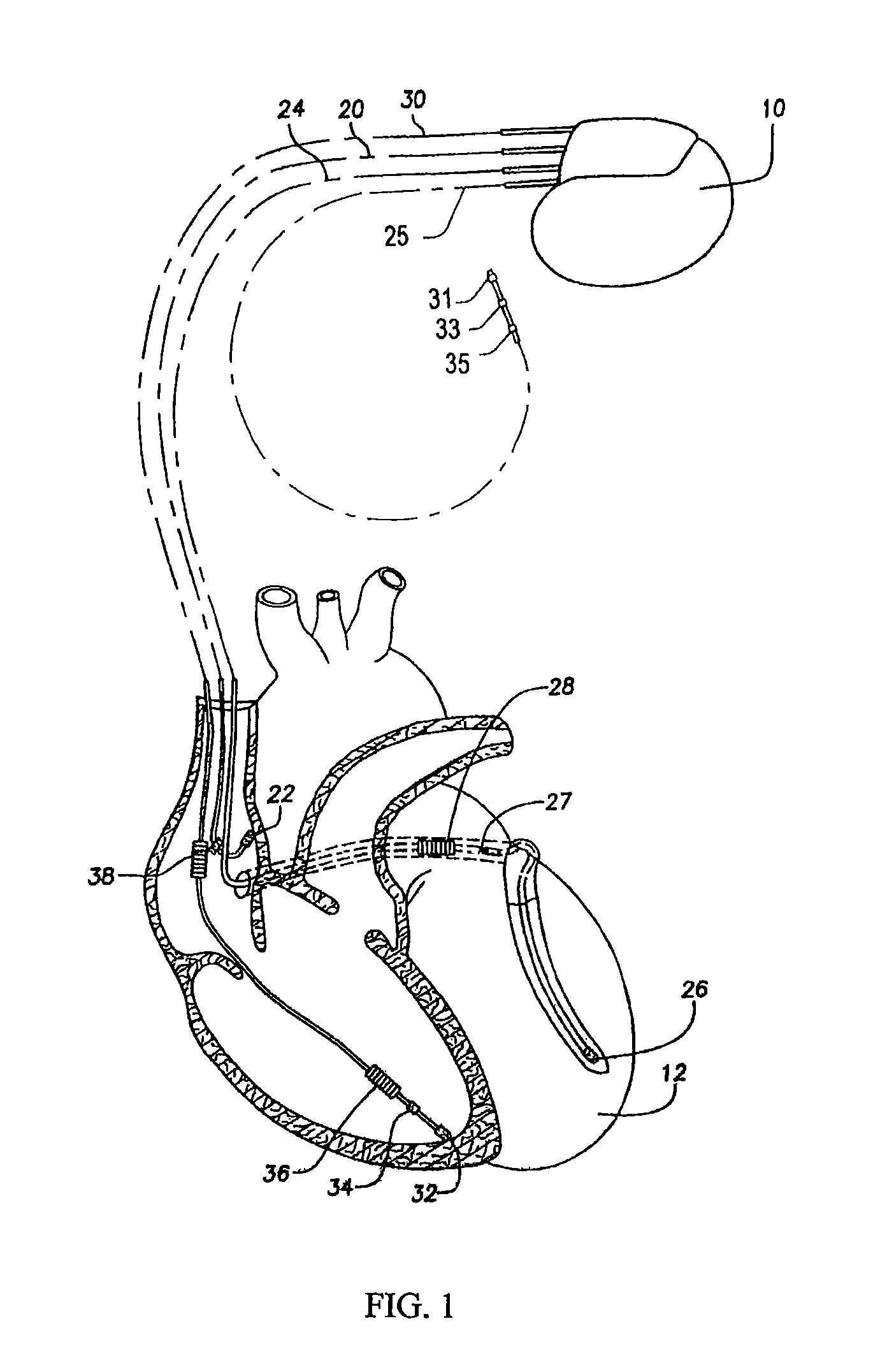 Systems and methods for detecting ischemic events