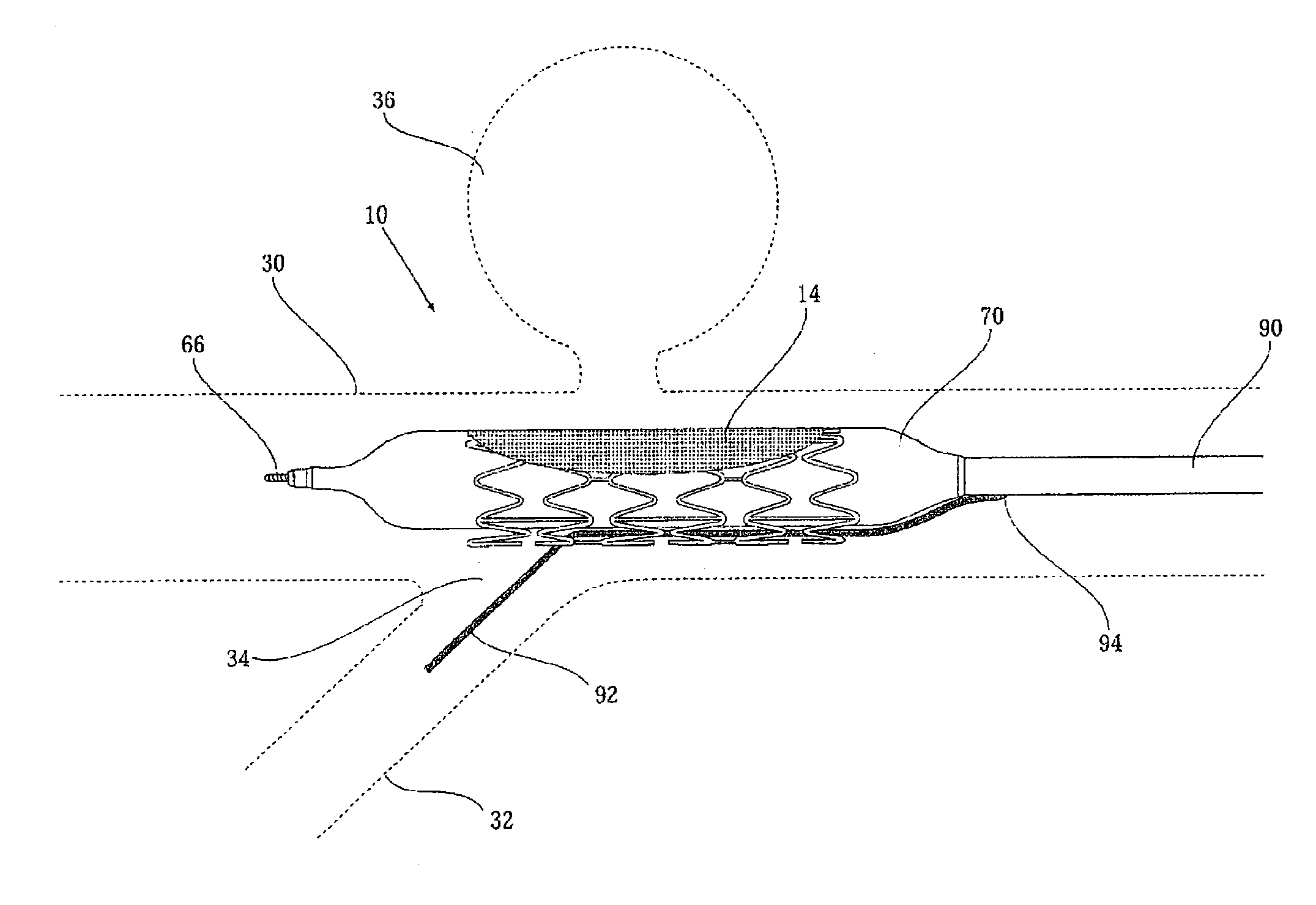 Implantable graft assembly