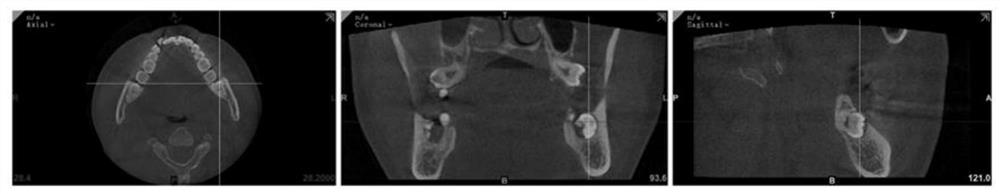 3D printing mandible impacted wisdom tooth extraction training model