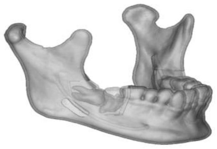 3D printing mandible impacted wisdom tooth extraction training model