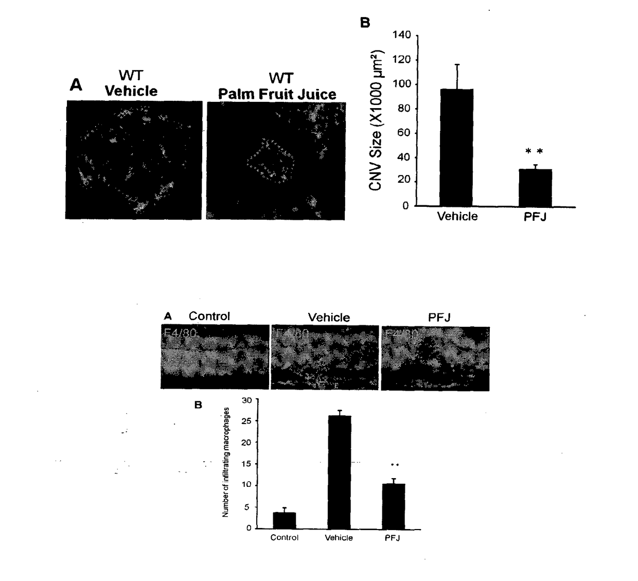 Compositions comprising extracts or materials derived from palm oil vegetation liquor for inhibition of vision loss due to angiogenesis and method of preparation there