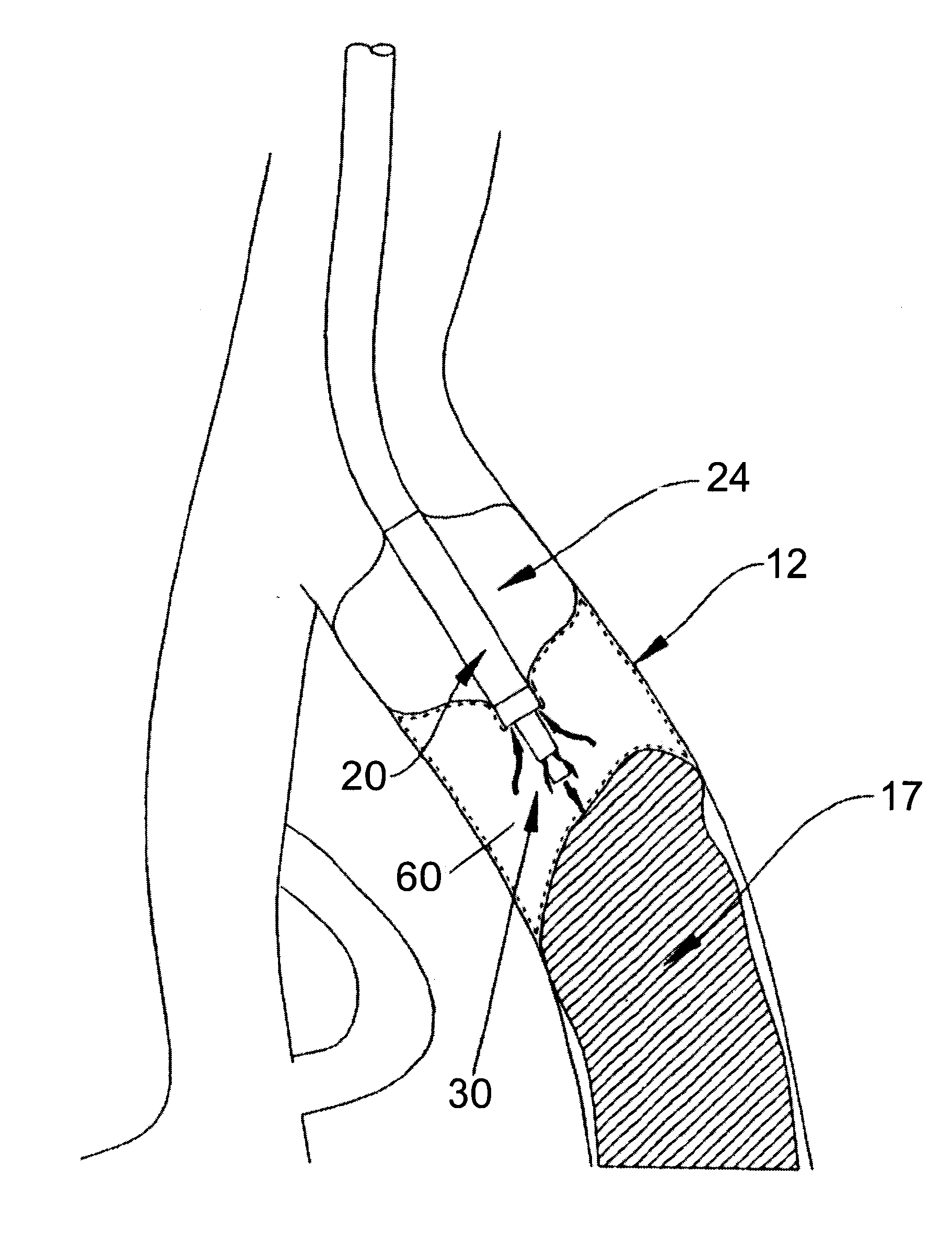 Catheter devices and methods for their use in the treatment of calcified vascular occlusions