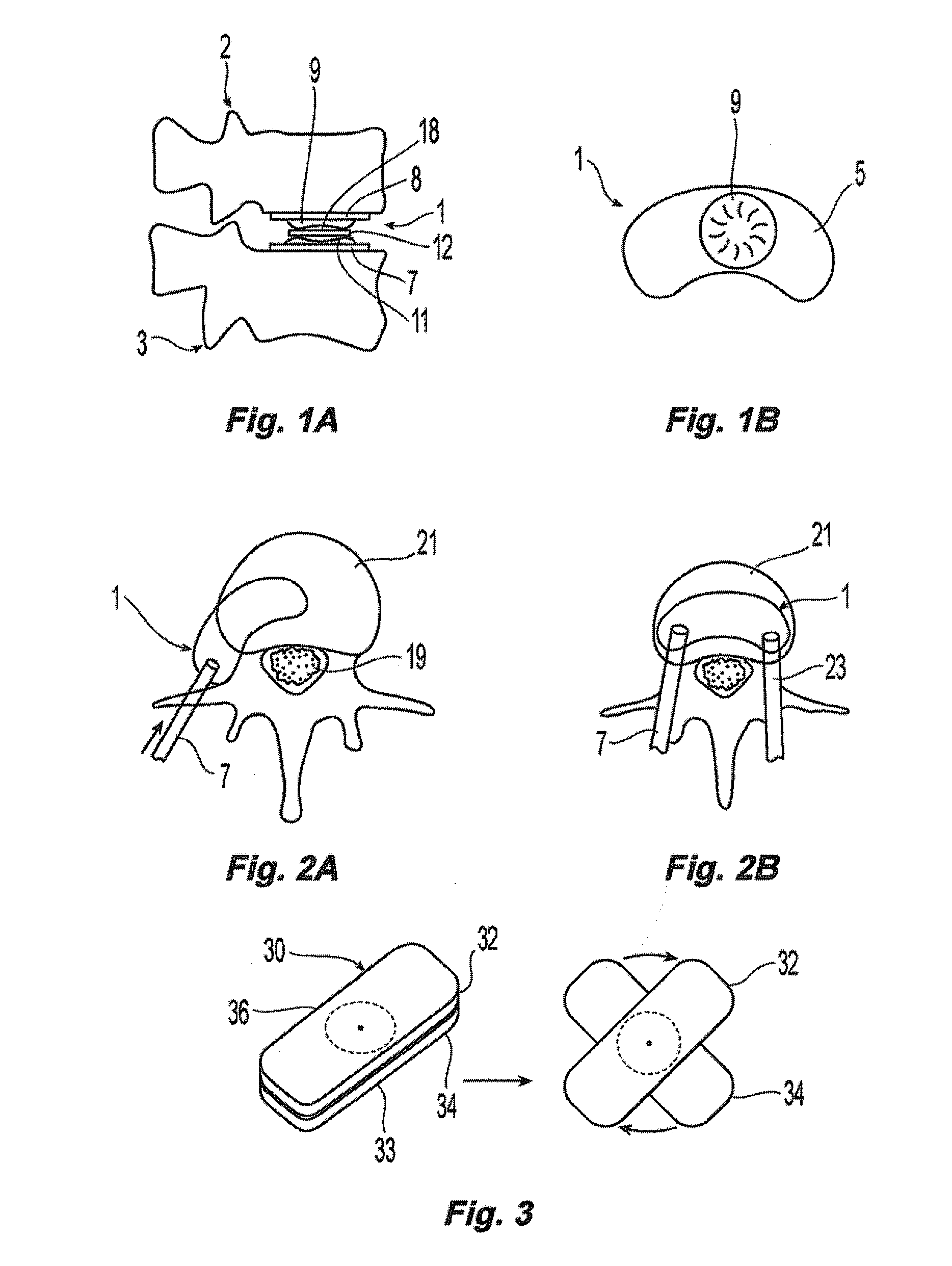 Prosthetic Spinal Disc Replacement