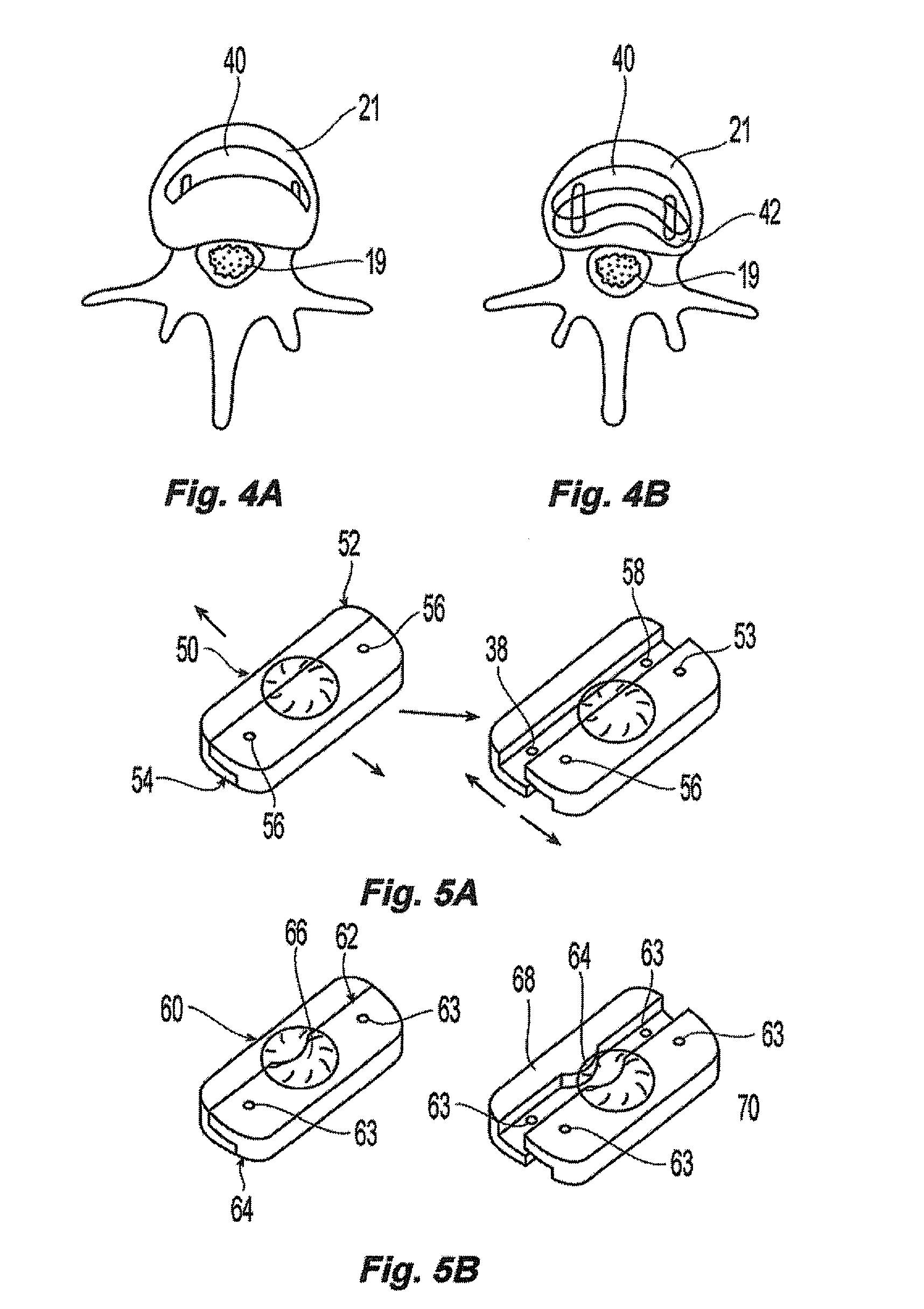 Prosthetic Spinal Disc Replacement