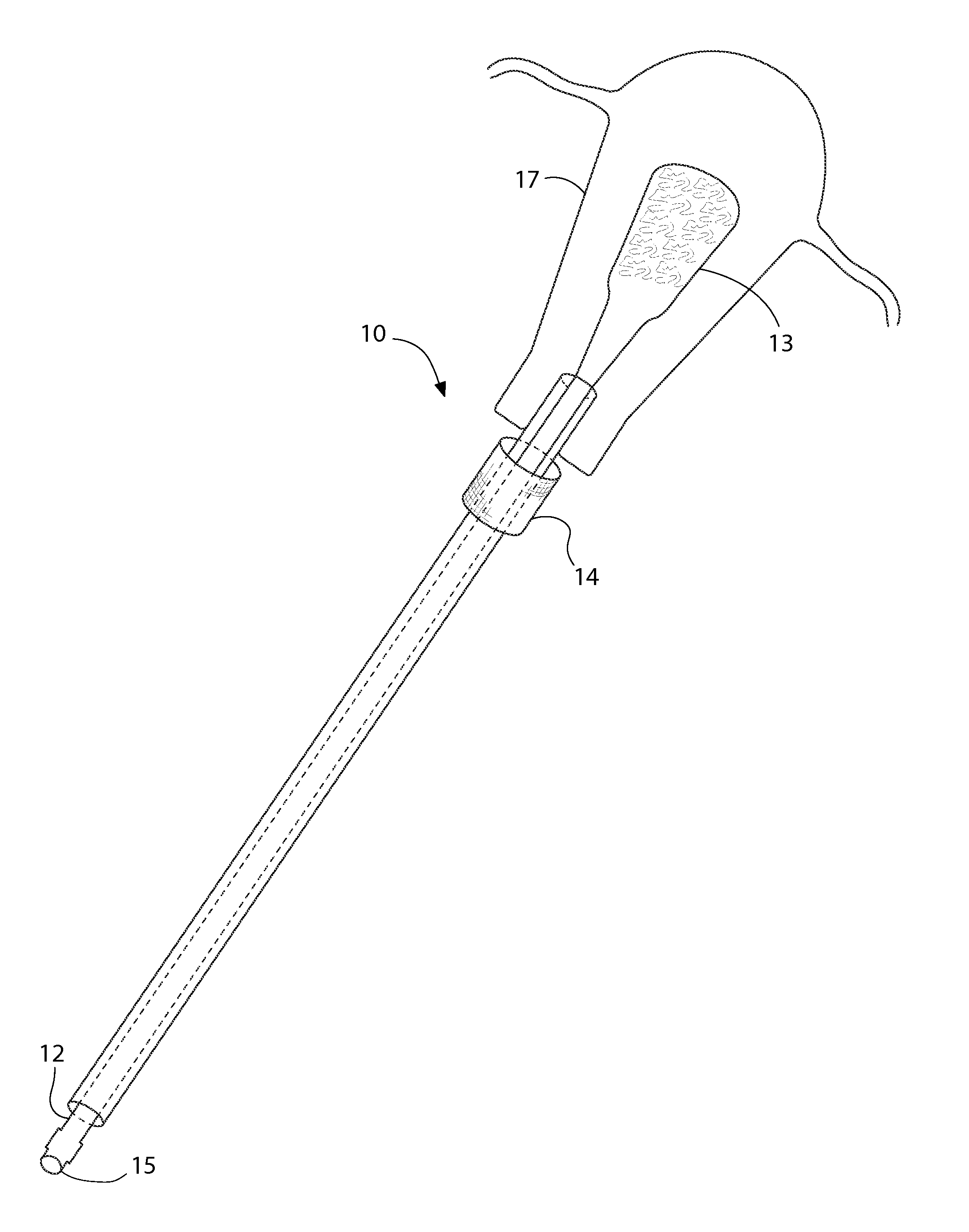 Device for instillation of a chemical agent into the endometrial cavity for purpose of global endometrial ablation