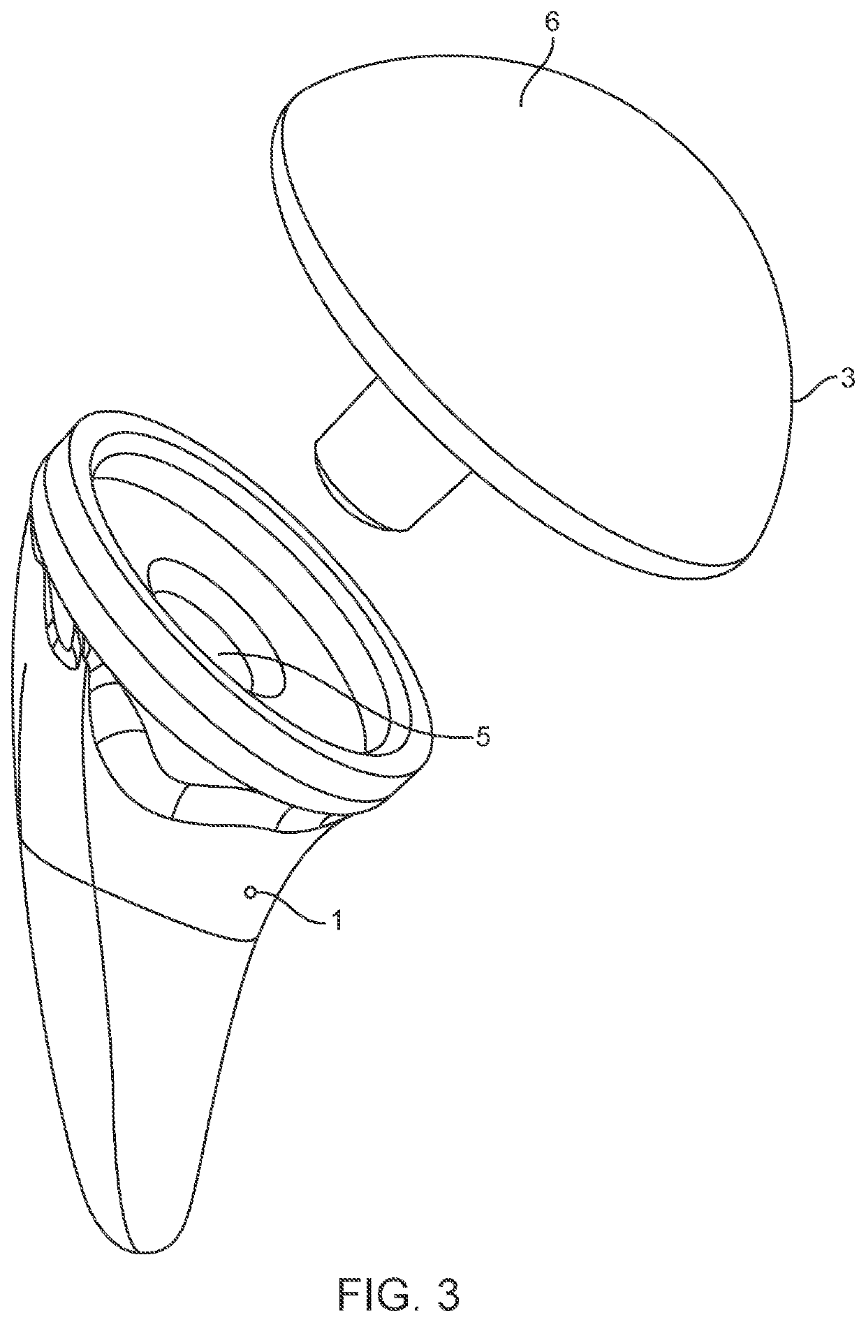 Shoulder arthroplasty implant system