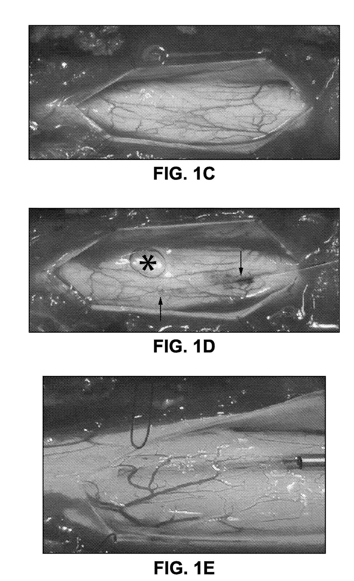 Spinal subpial gene delivery system