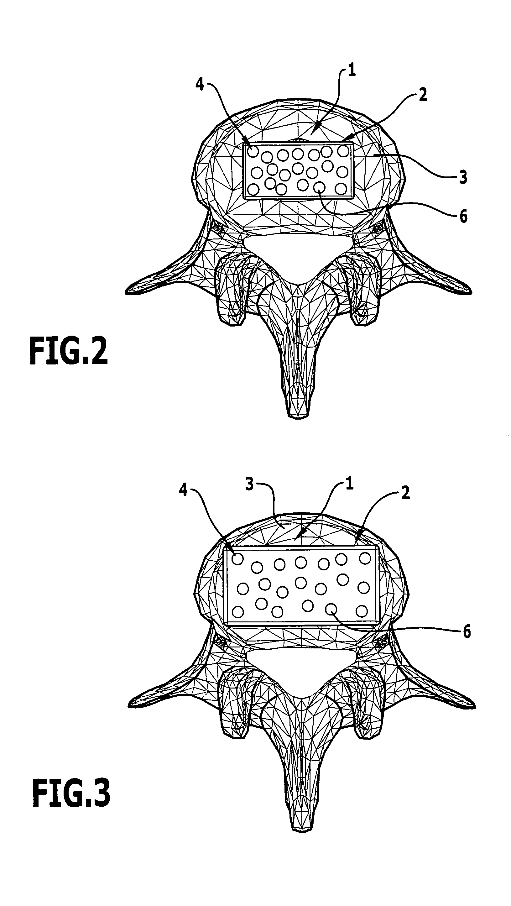 Intervertebral implant