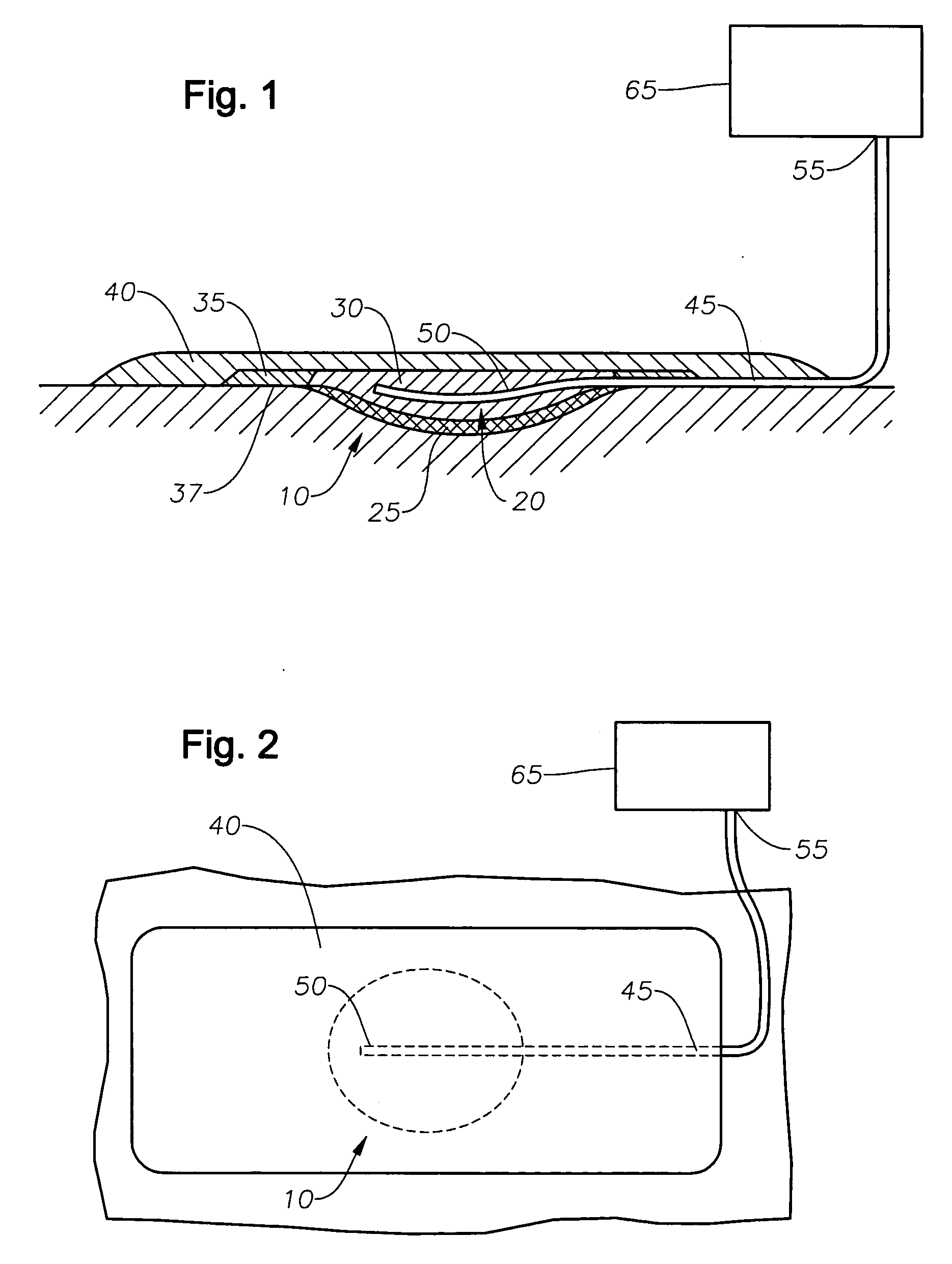 Method and apparatus for treating a wound