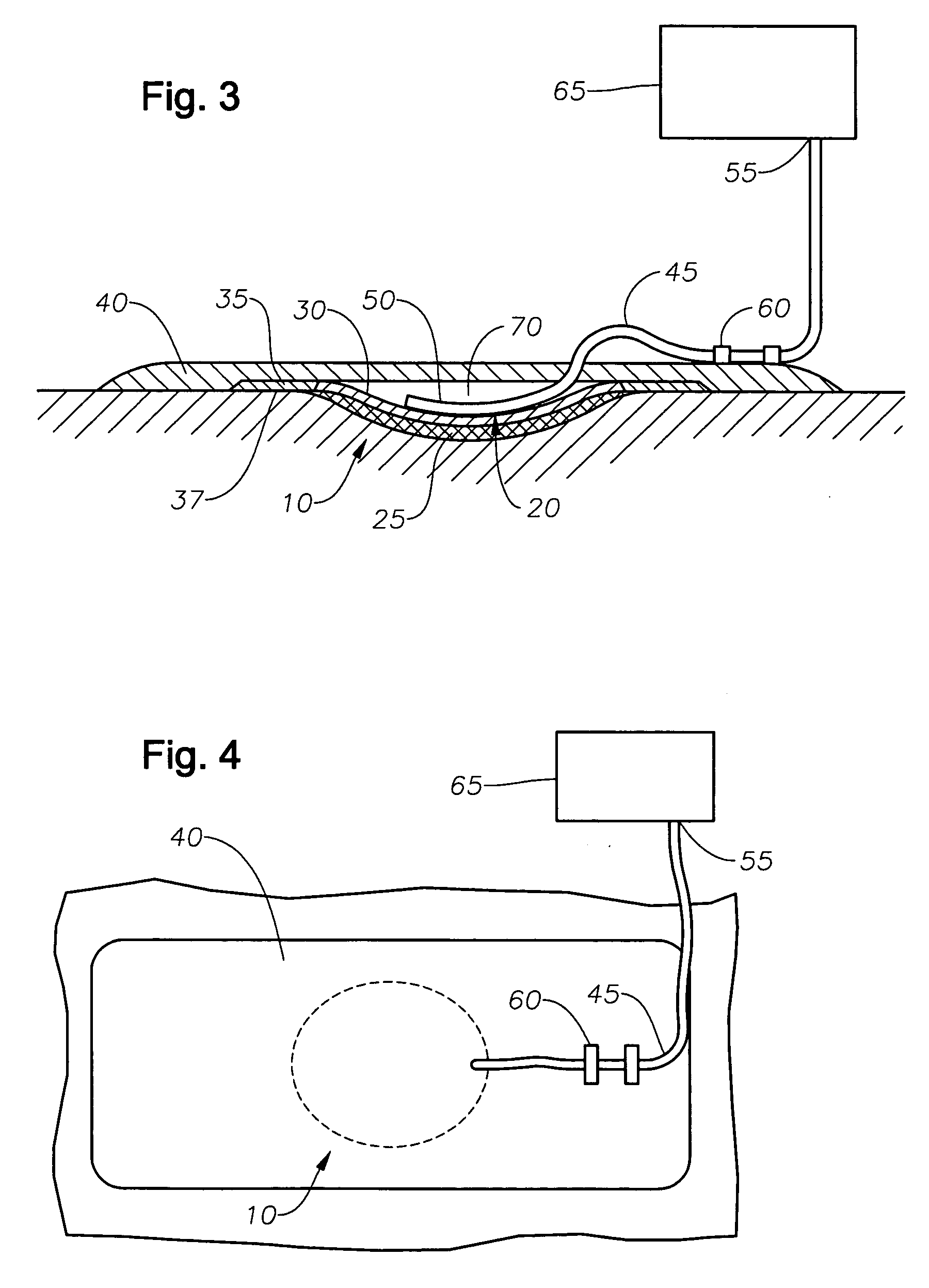 Method and apparatus for treating a wound