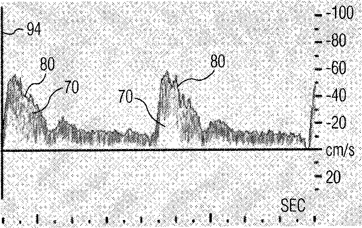 Ultrasonic diagnostic imaging system with spectral and audio tissue doppler