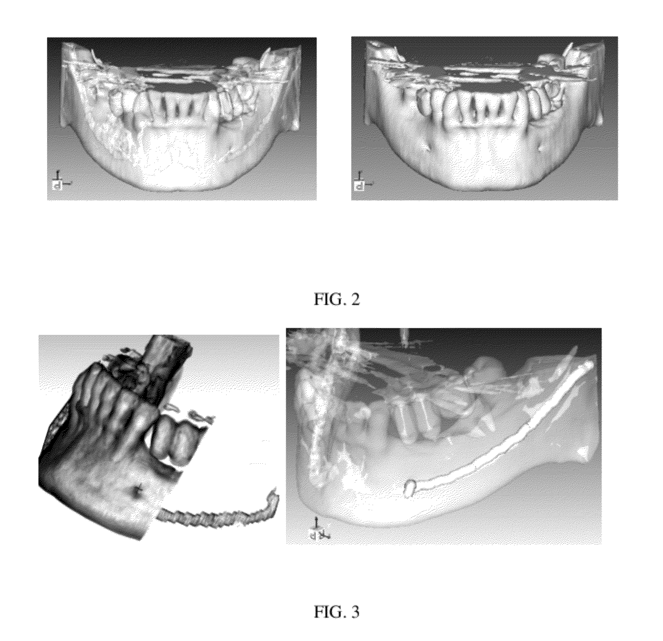 Hybrid method for dental implant treatment planning