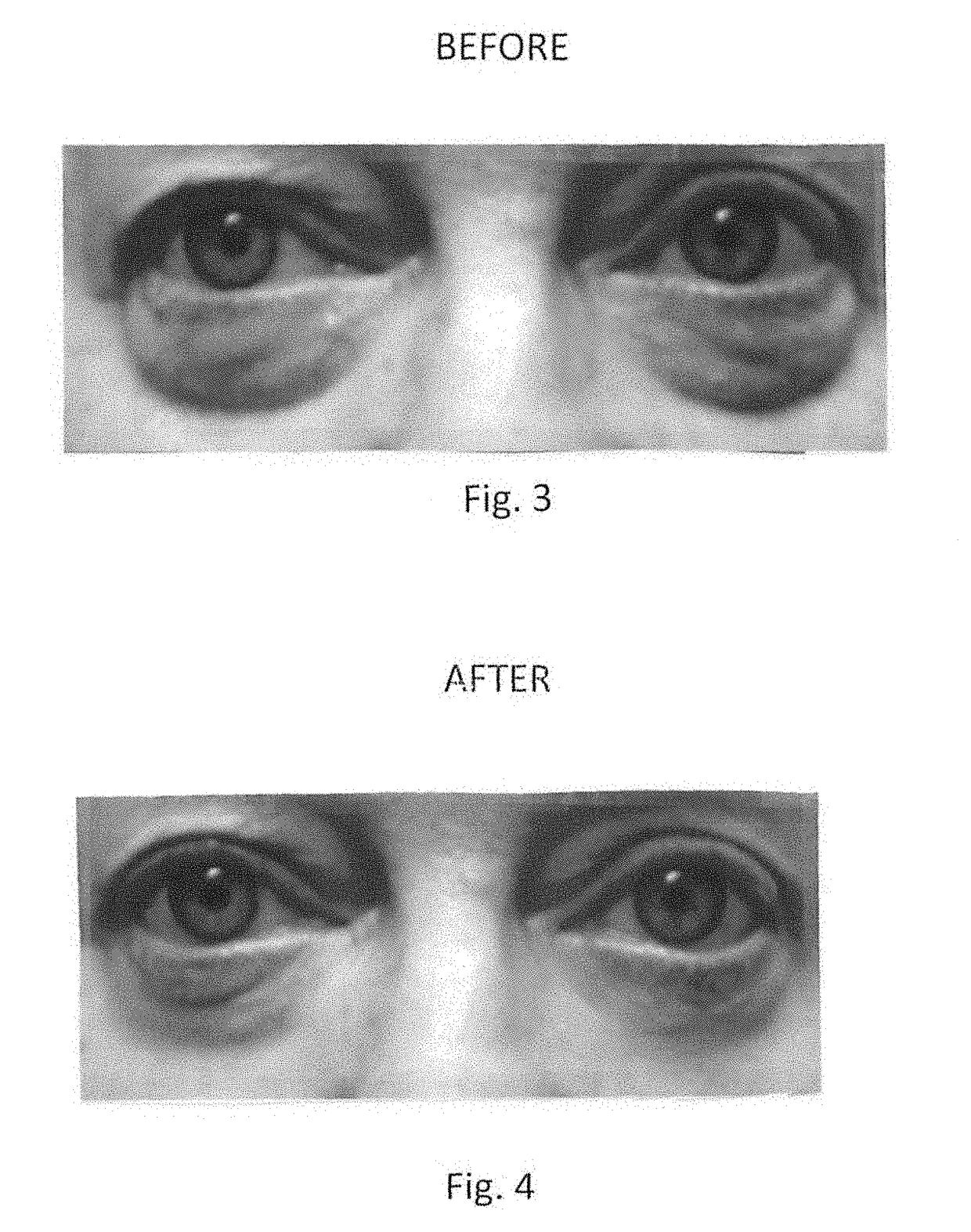 Topical composition for skin treatment to reduce lines and wrinkles of the face and body using a dual DNA repair mechanism to address damage caused by aging and ultra-violet induced damage to the skin with combination of skin turgor enhancement compounds