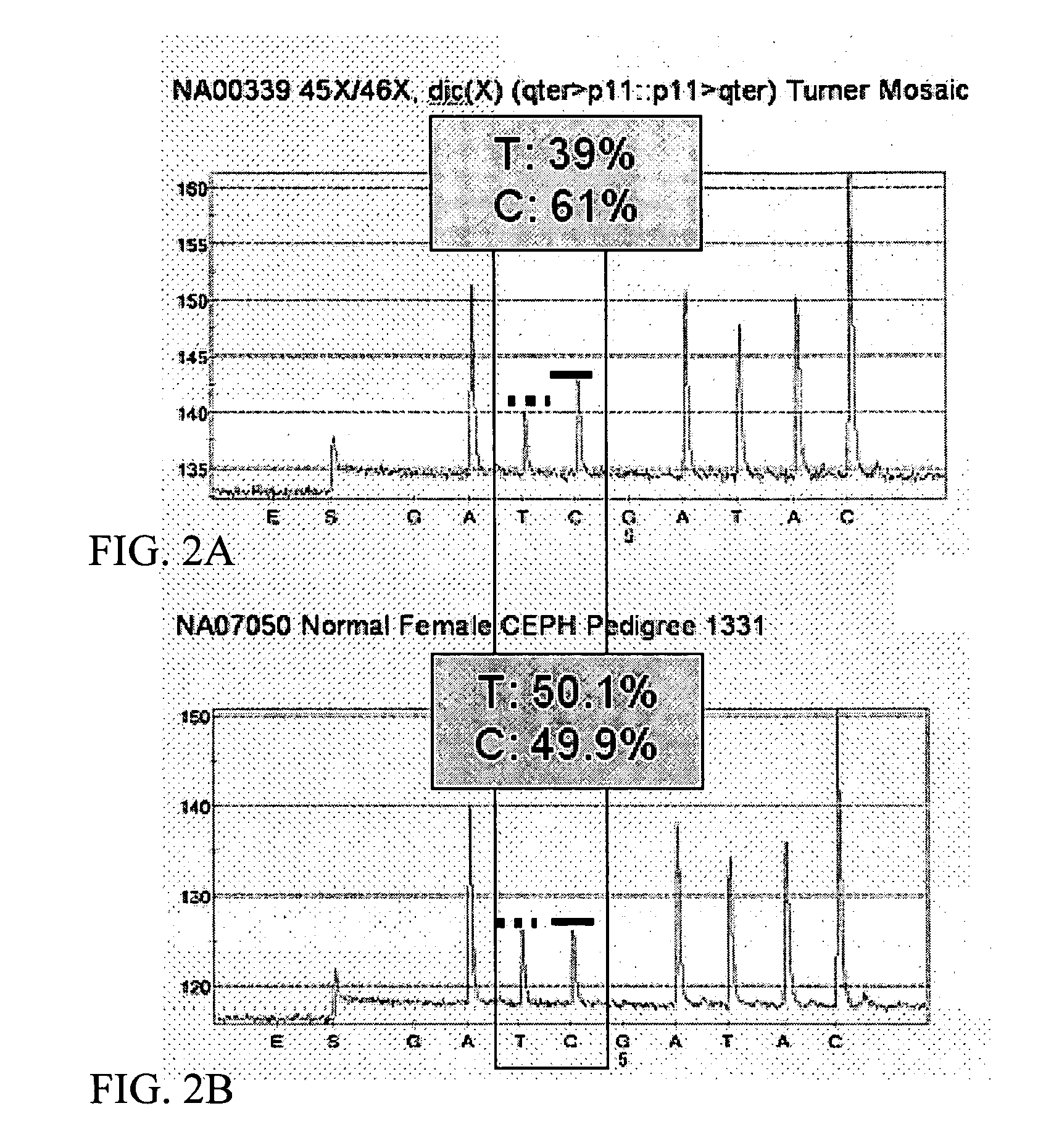 DNA diagnostic screening for turner syndrome and sex chromosome disorders