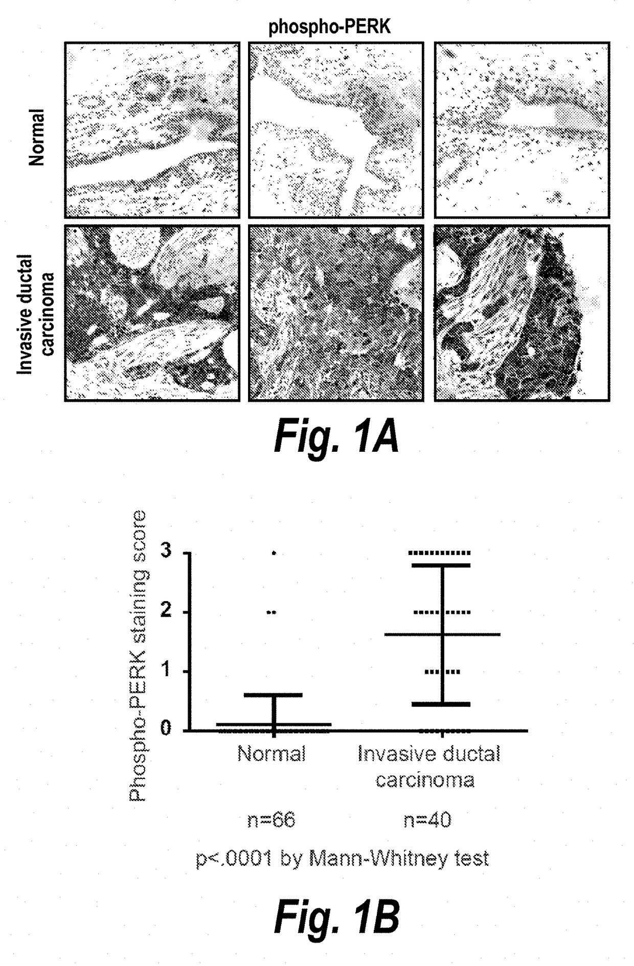 Modulation of breast cancer growth by modulation of xbp1 activity