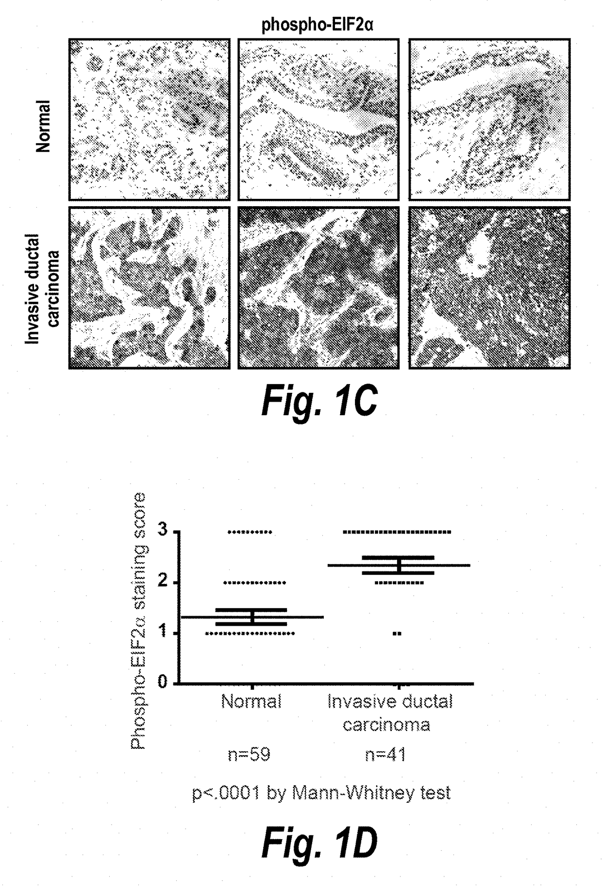 Modulation of breast cancer growth by modulation of xbp1 activity