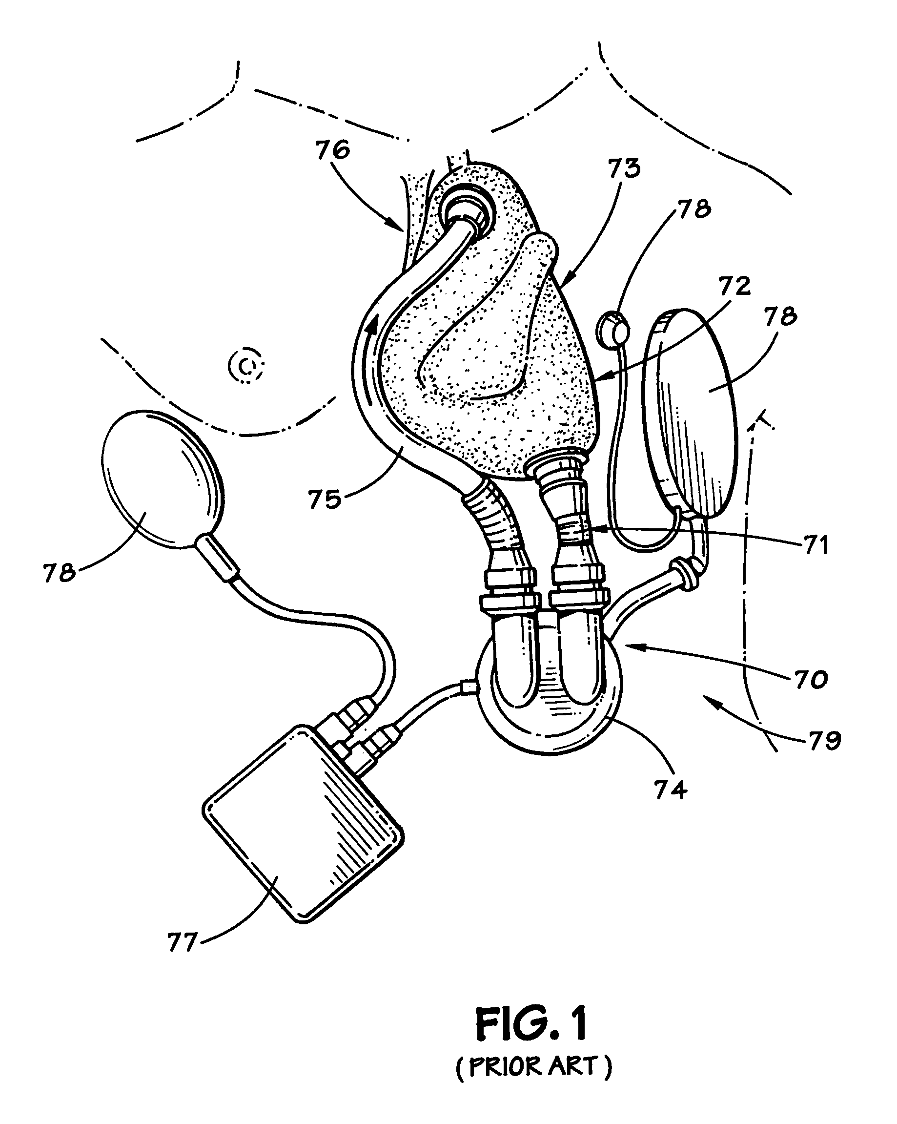 Method and apparatus for long-term assisting a left ventricle to pump blood