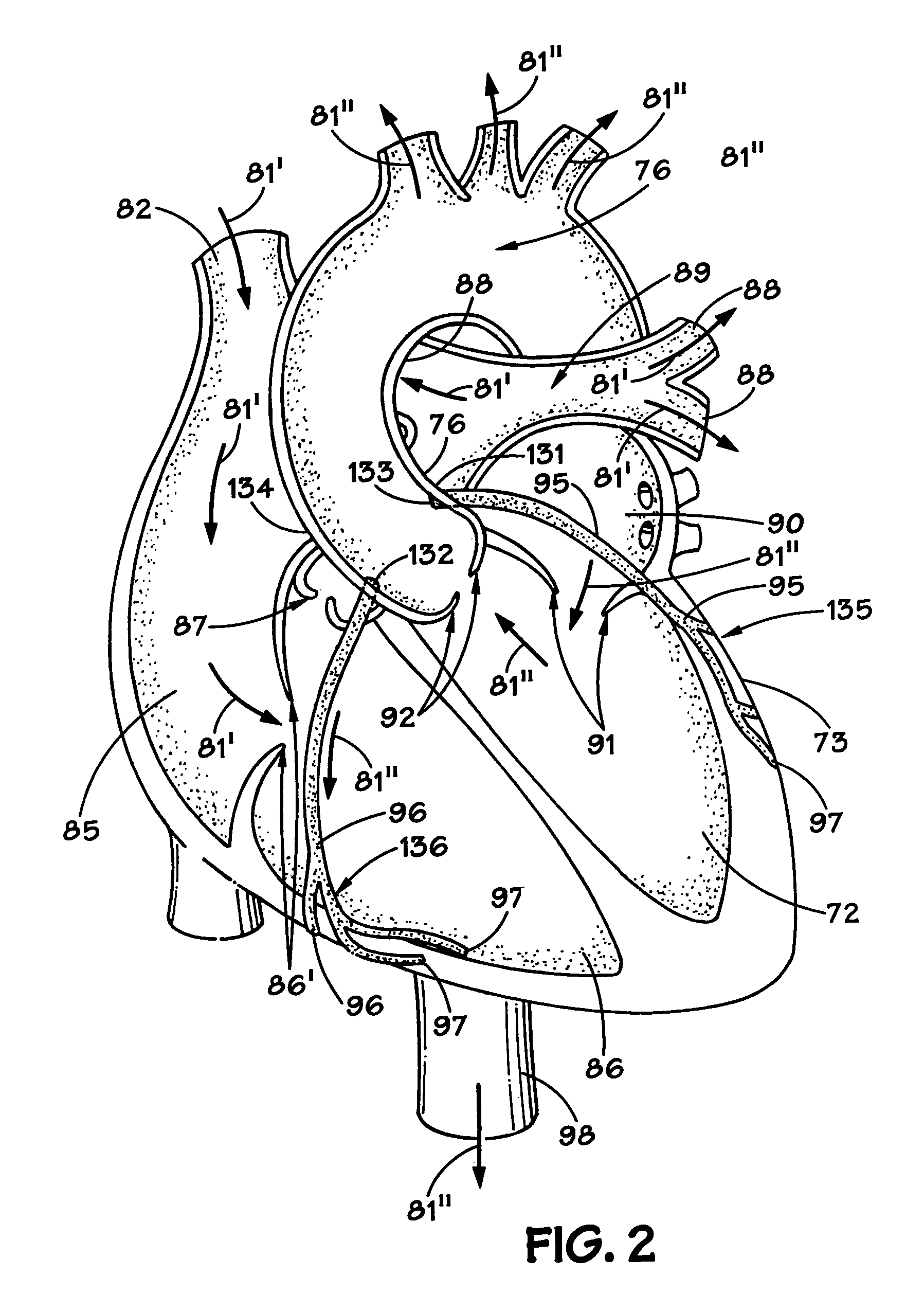 Method and apparatus for long-term assisting a left ventricle to pump blood