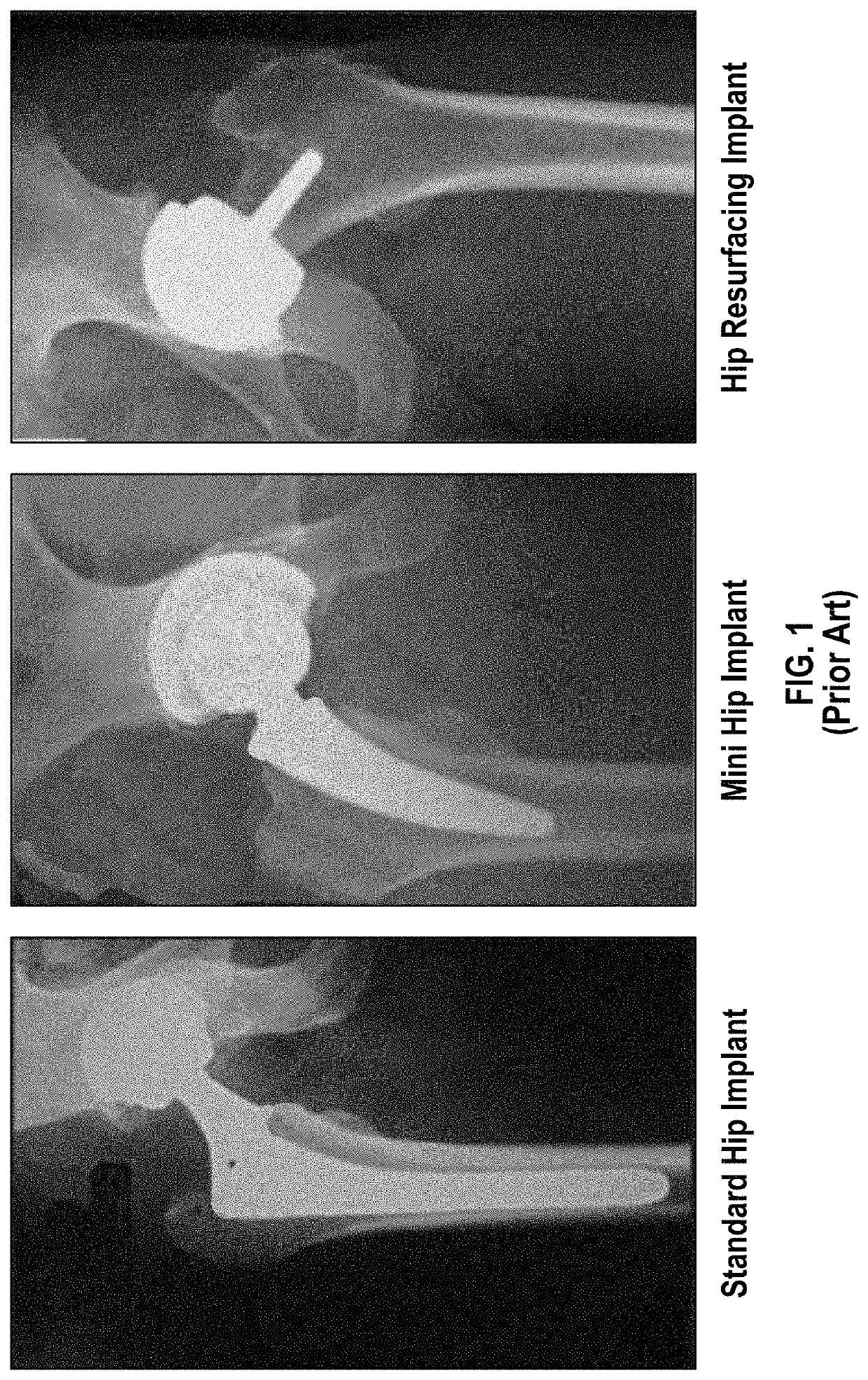 Hip implant device