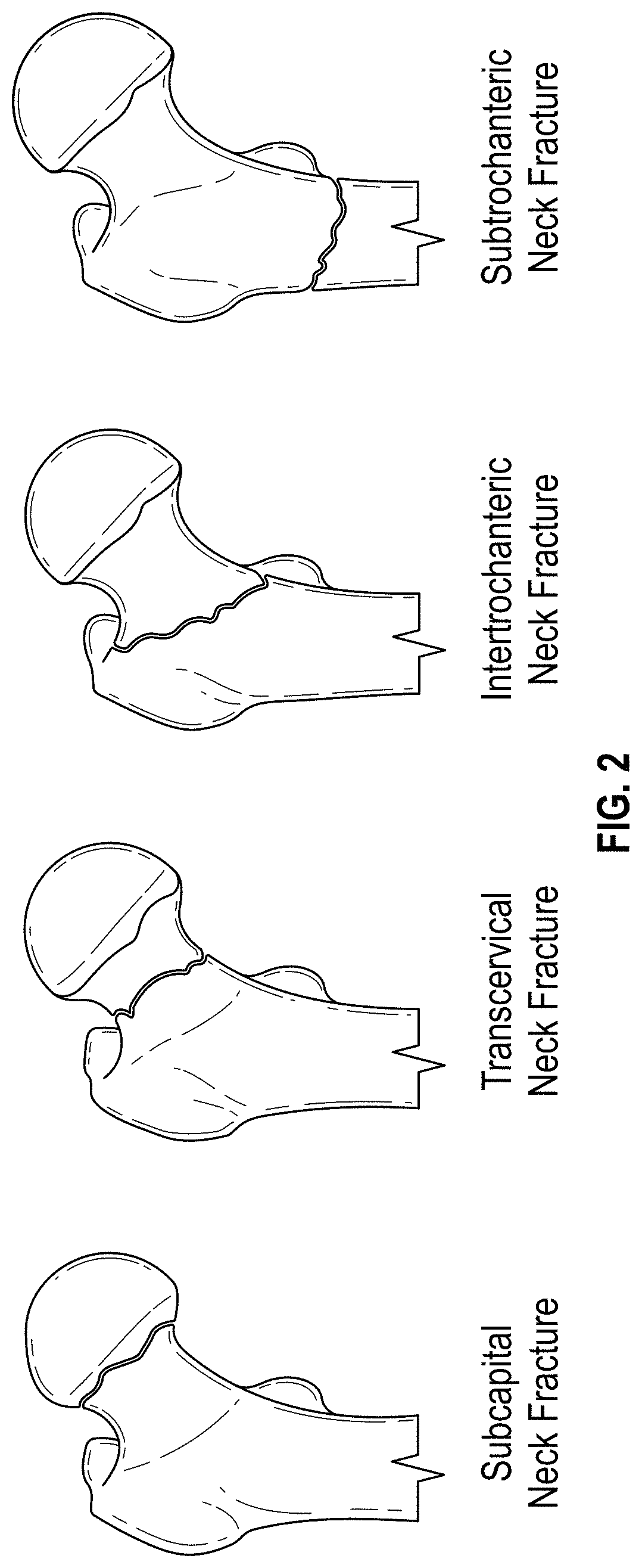 Hip implant device