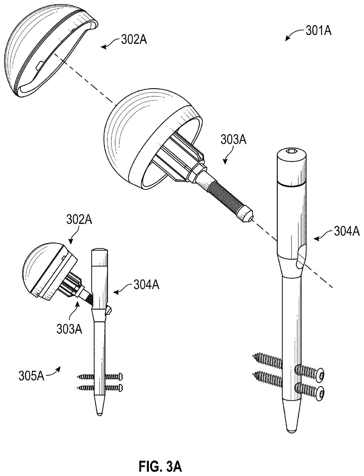 Hip implant device