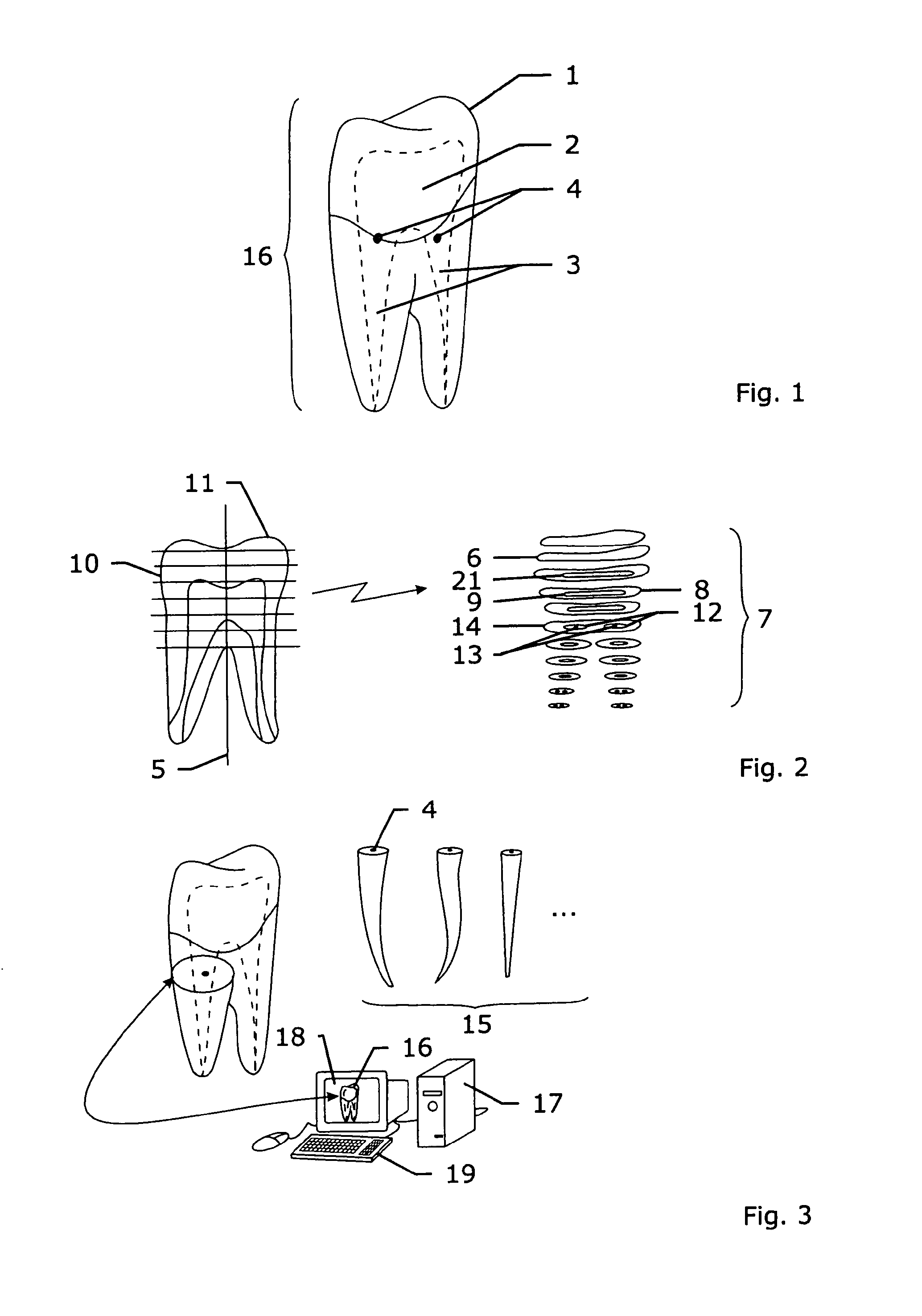 Method and system for establishing the shape of the occlusal access cavity in endodontic treatment