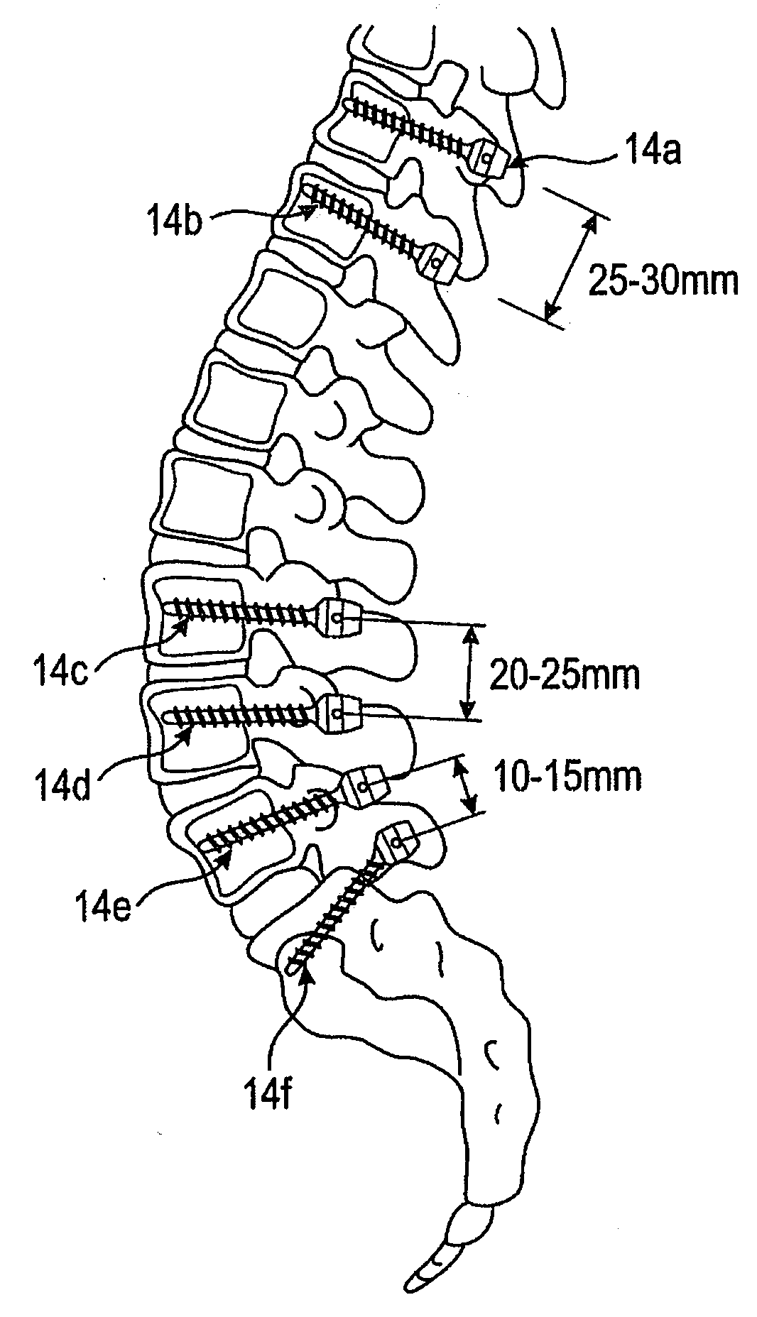 Rod connection in a surgical device and rod-shaped bone stabilization device comprising the same