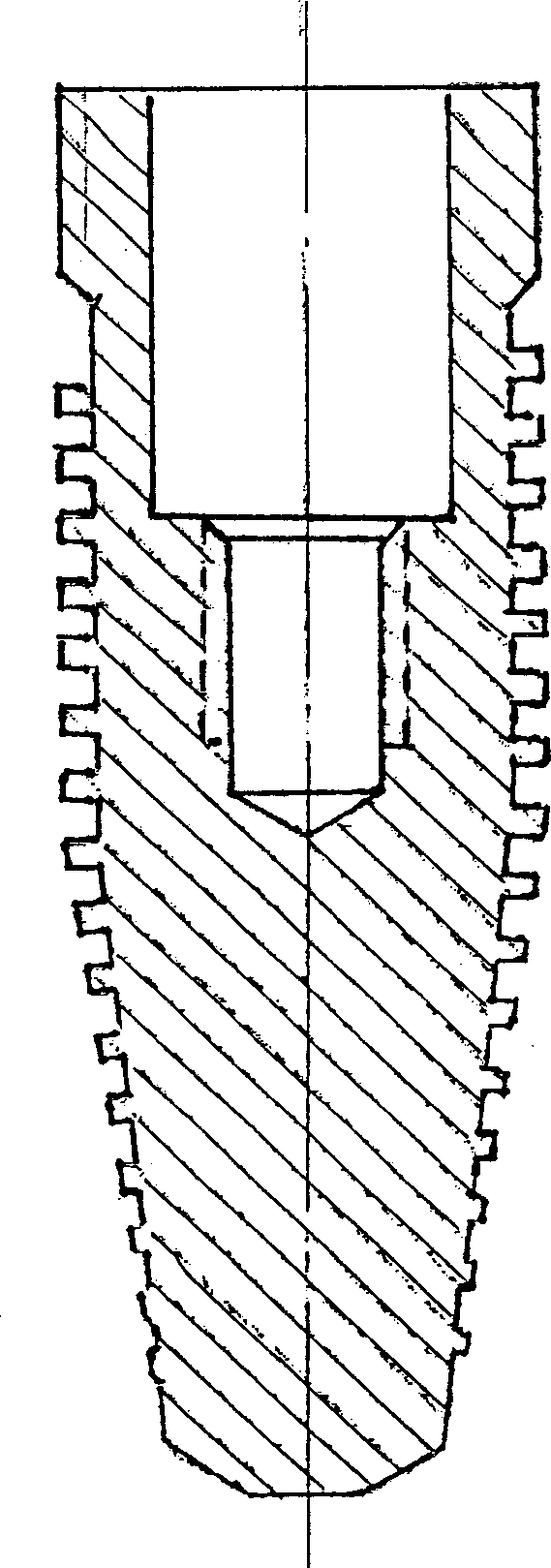 Spiral structure type osteo-tooth implant coated with nano-apatite layer