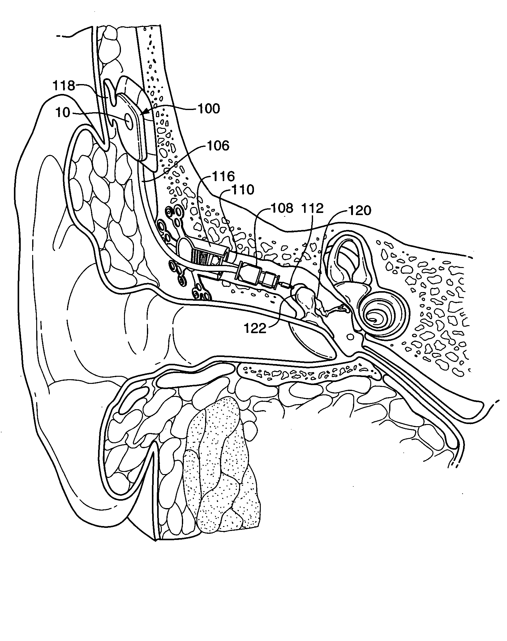 Passive vibration isolation of implanted microphone