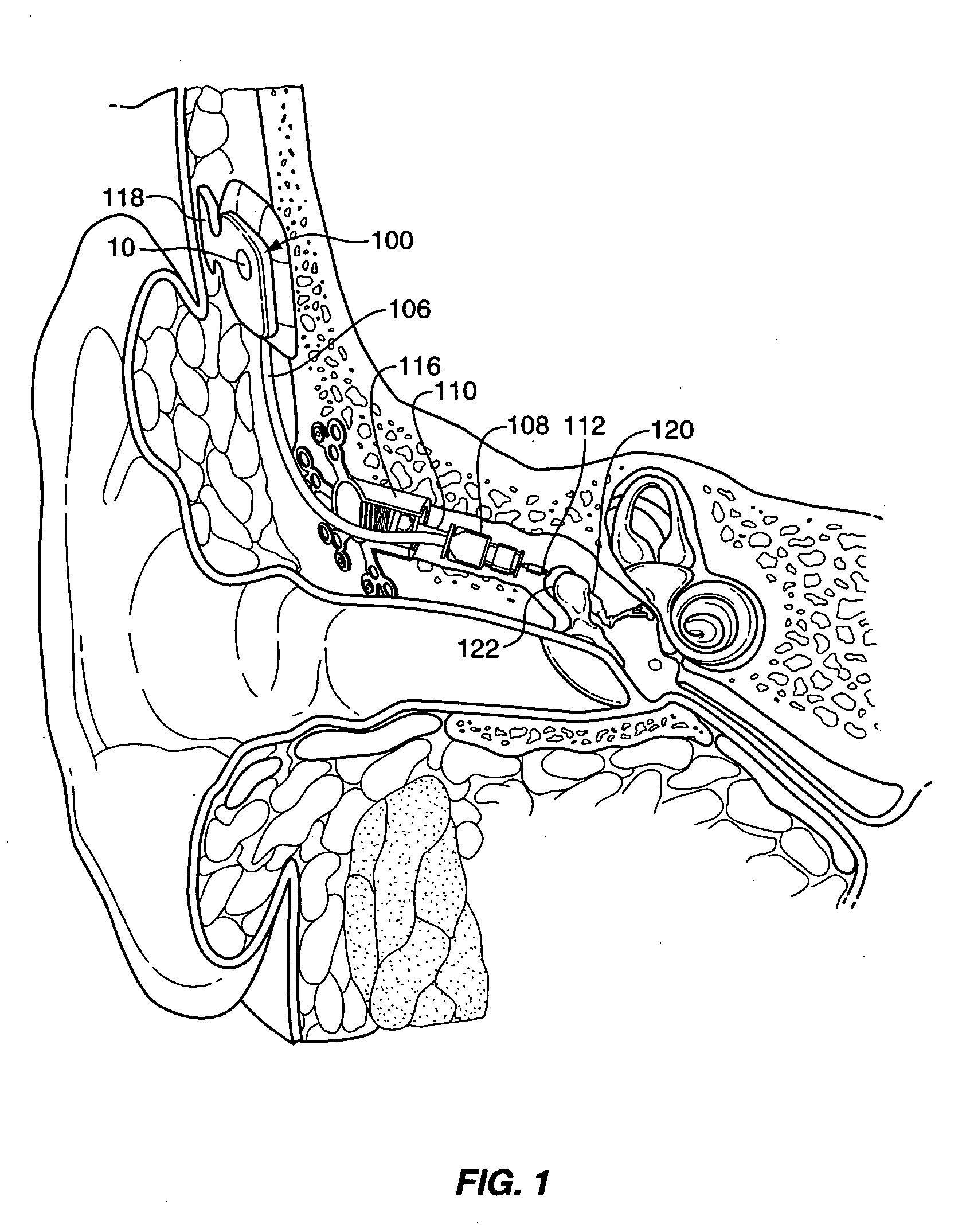 Passive vibration isolation of implanted microphone