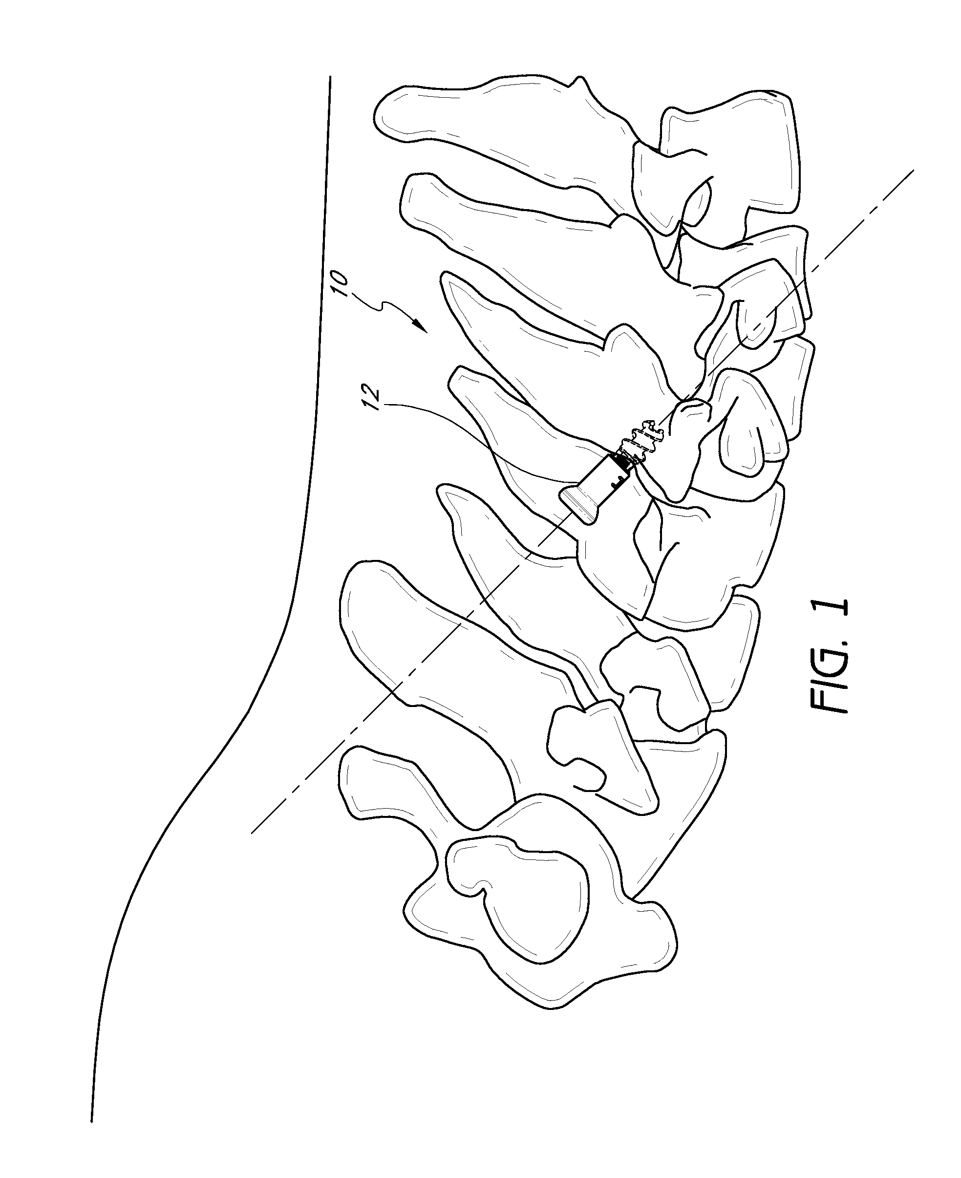 Method and apparatus for spinal fixation